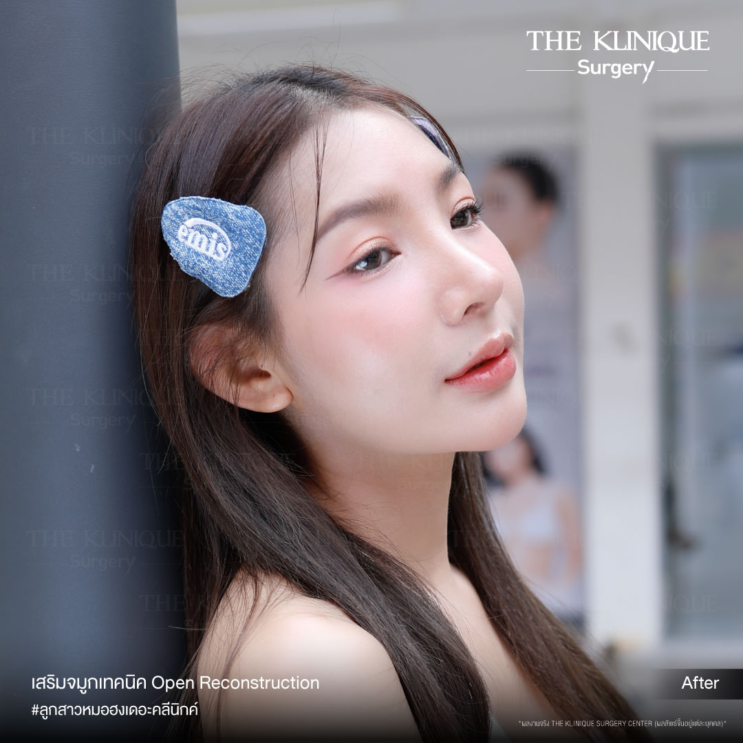เสริมจมูก, ศัลยกรรมจมูก, ศัลยกรรมจมูก รีวิว, รีวิว เสริมจมูก, ศัลยกรรมจมูกมีกี่แบบ, เสริมจมูกที่ไหนดี, เสริมจมูกโอเพ่น, เสริมจมูกราคา, รีวิวเสริมจมูก, ทำจมูก, ทำจมูก รีวิว, รีวิวทำจมูก, รีวิว ศัลยกรรมจมูก, ซิลิโคนจมูก, แก้จมูก, แก้จมูก รีวิว, รีวิวแก้จมูก, แก้จมูกที่ไหนดี, เสริมจมูก Close, เสริมจมูก semi open, จมูก open, เสริมจมูก Open ที่ไหนดี, รีวิว เสริมจมูก Open, เสริมจมูกโอเพ่น, เสริมจมูกโอเพ่นที่ไหนดี, ทรงจมูก, ทรงจมูกสวย, ทรงจมูกเกาหลี, ทรงจมูกธรรมชาติ, ทรงจมูกสโลปปลายพุ่ง, ทรงจมูกผู้ชาย