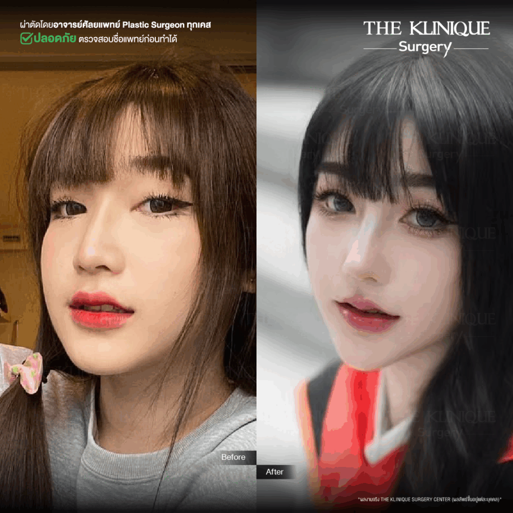เสริมจมูก, ศัลยกรรมจมูก, ศัลยกรรมจมูก รีวิว, รีวิว เสริมจมูก, ศัลยกรรมจมูกมีกี่แบบ, เสริมจมูกที่ไหนดี, เสริมจมูกโอเพ่น, เสริมจมูกราคา, รีวิวเสริมจมูก, ทำจมูก, ทำจมูก รีวิว, รีวิวทำจมูก, รีวิว ศัลยกรรมจมูก, ซิลิโคนจมูก, แก้จมูก, แก้จมูก รีวิว, รีวิวแก้จมูก, แก้จมูกที่ไหนดี, เสริมจมูก Close, เสริมจมูก semi open, จมูก open, เสริมจมูก Open ที่ไหนดี, รีวิว เสริมจมูก Open, เสริมจมูกโอเพ่น, เสริมจมูกโอเพ่นที่ไหนดี, ทรงจมูก, ทรงจมูกสวย, ทรงจมูกเกาหลี, ทรงจมูกธรรมชาติ, ทรงจมูกสโลปปลายพุ่ง, ทรงจมูกผู้ชาย