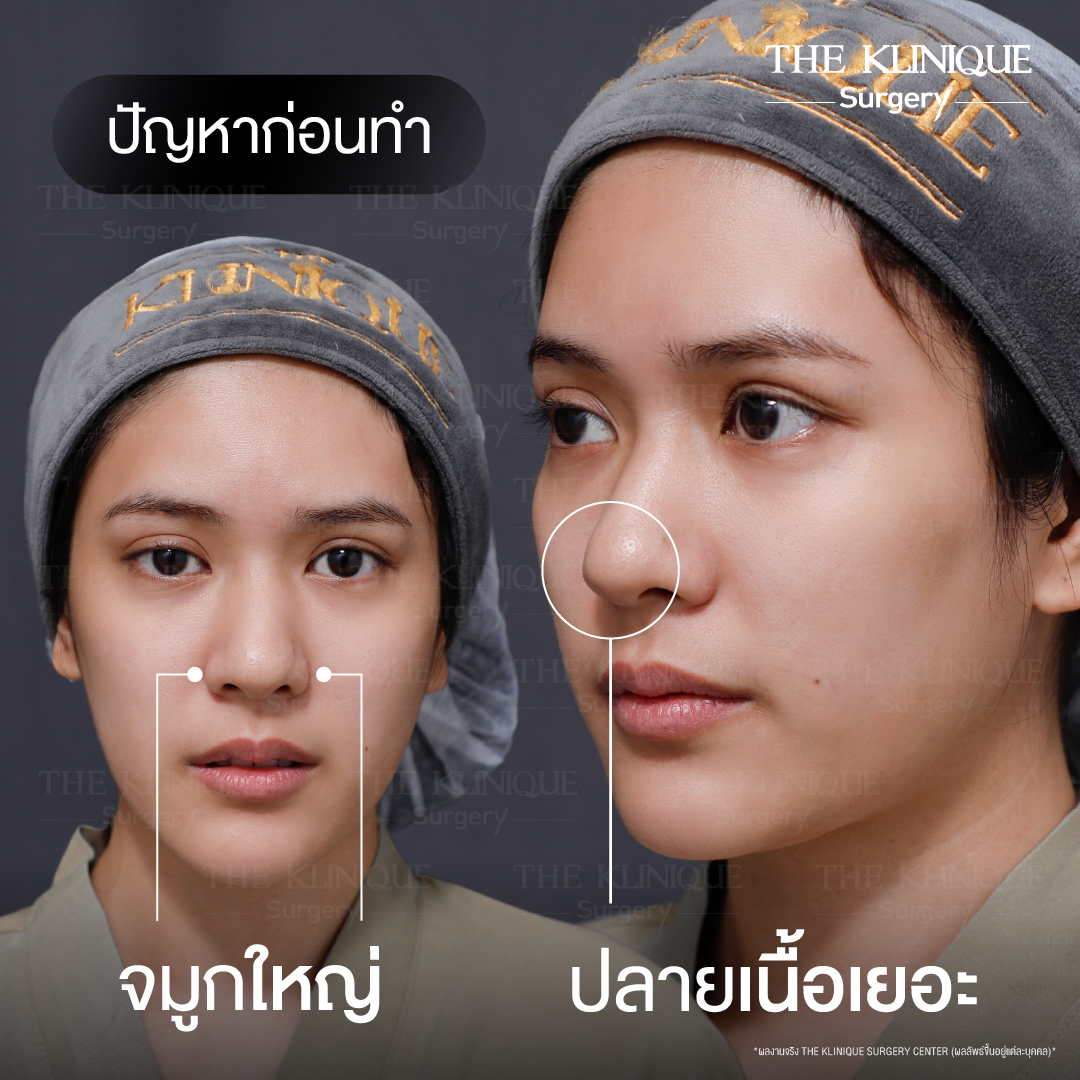ศัลยกรรมจมูก, เสริมจมูก, เสริมจมูกที่ไหนดี, เสริมจมูกราคา, รีวิว เสริมจมูก, ทำจมูก, ทำจมูก รีวิว,เสริมจมูก Semi Open, เสริมจมูก Open, เสริมจมูก โอเพ่น, ซิลิโคนจมูก, จมูกOpen, รีวิวเสริมจมูกโอเพ่น, รีวิวเสริมจมูก Open, ทรงจมูก, ทรงจมูกสวย, ทรงจมูกเกาหลี, ทรงจมูกธรรมชาติ, ทรงจมูกสันสโลปปลายพุ่ง,รีวิวจมูกOpen, หลังเสริมจมูก, ศัลยกรรมเสริมจมูก, ศัลยกรรมเสริมจมูกราคา, ศัลยกรรมเสริมจมูกที่ไหนดี, เสริมจมูกที่ไหนดี, ศัลยกรรมจมูกมีกี่แบบ, เสริมจมูก Close, เสริมจมูก Open ที่ไหนดี, เสริมจมูกโอเพ่นทีไ่หนดี, รีวิวจมูกOpen, รีวิวเสริมจมูกOpen, แก้จมูก, แก้จมูกที่ไหนดี