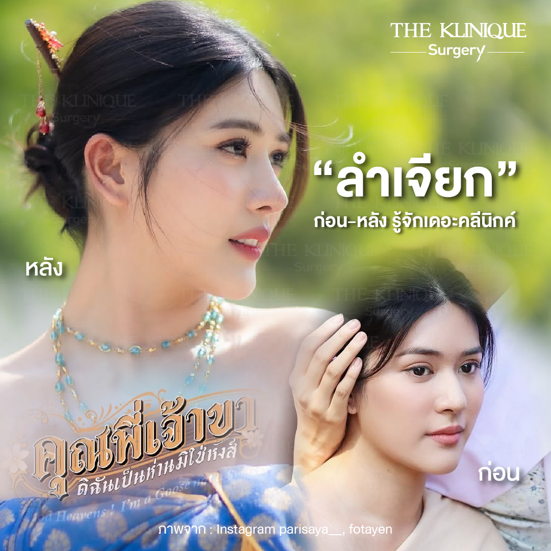 ศัลยกรรมจมูก, เสริมจมูก, เสริมจมูกที่ไหนดี, เสริมจมูกราคา, รีวิว เสริมจมูก, ทำจมูก, ทำจมูก รีวิว,เสริมจมูก Semi Open, เสริมจมูก Open, เสริมจมูก โอเพ่น, ซิลิโคนจมูก, จมูกOpen, รีวิวเสริมจมูกโอเพ่น, รีวิวเสริมจมูก Open, ทรงจมูก, ทรงจมูกสวย, ทรงจมูกเกาหลี, ทรงจมูกธรรมชาติ, ทรงจมูกสันสโลปปลายพุ่ง,รีวิวจมูกOpen, หลังเสริมจมูก, ศัลยกรรมเสริมจมูก, ศัลยกรรมเสริมจมูกราคา, ศัลยกรรมเสริมจมูกที่ไหนดี, เสริมจมูกที่ไหนดี, ศัลยกรรมจมูกมีกี่แบบ, เสริมจมูก Close, เสริมจมูก Open ที่ไหนดี, เสริมจมูกโอเพ่นทีไ่หนดี, รีวิวจมูกOpen, รีวิวเสริมจมูกOpen, แก้จมูก, แก้จมูกที่ไหนดี