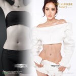 Liposuction, Sculpting,Xshape,Lipo, ศัลยกรรมดูดไขมัน, ดูดไขมัน,คลินิกดูดไขมัน,ดูดไขมันเฉพาะส่วน,ดูดไขมันเหนียง,ดูดไขมันหน้าท้อง,ดูดไขมันรีวิว, รีวิวดูดไขมัน, รีวิวดูดไขมันหน้าท้อง,ดูดไขมันต้นแขน, ดูดไขมันต้นขา,ดูดไขมันน่อง, ลดความอ้วน, ดูดไขมันที่ไหนดี, ดูดไขมันราคา, ดูดไขมันทั้งตัว, รีวิว ดูดไขมันต้นขา, ดูดไขมันขา