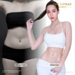Liposuction, Sculpting,Xshape,Lipo, ศัลยกรรมดูดไขมัน, ดูดไขมัน,คลินิกดูดไขมัน,ดูดไขมันเฉพาะส่วน,ดูดไขมันเหนียง,ดูดไขมันหน้าท้อง,ดูดไขมันรีวิว, รีวิวดูดไขมัน, รีวิวดูดไขมันหน้าท้อง,ดูดไขมันต้นแขน, ดูดไขมันต้นขา,ดูดไขมันน่อง, ลดความอ้วน, ดูดไขมันที่ไหนดี, ดูดไขมันราคา, ดูดไขมันทั้งตัว, รีวิว ดูดไขมันต้นขา, ดูดไขมันขา