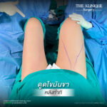 Liposuction, Sculpting,Xshape,Lipo, ศัลยกรรมดูดไขมัน, ดูดไขมัน,คลินิกดูดไขมัน,ดูดไขมันเฉพาะส่วน,ดูดไขมันเหนียง,ดูดไขมันหน้าท้อง,ดูดไขมันรีวิว, รีวิวดูดไขมัน, รีวิวดูดไขมันหน้าท้อง,ดูดไขมันต้นแขน, ดูดไขมันต้นขา,ดูดไขมันน่อง, ลดความอ้วน, ดูดไขมันที่ไหนดี, ดูดไขมันราคา, ดูดไขมันทั้งตัว, รีวิว ดูดไขมันต้นขา, ดูดไขมันขา