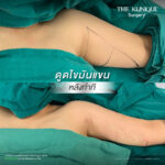 Liposuction, Sculpting,Xshape,Lipo, ศัลยกรรมดูดไขมัน, ดูดไขมัน,คลินิกดูดไขมัน,ดูดไขมันเฉพาะส่วน,ดูดไขมันเหนียง,ดูดไขมันหน้าท้อง,ดูดไขมันรีวิว, รีวิวดูดไขมัน, รีวิวดูดไขมันหน้าท้อง,ดูดไขมันต้นแขน, ดูดไขมันต้นขา,ดูดไขมันน่อง, ลดความอ้วน, ดูดไขมันที่ไหนดี, ดูดไขมันราคา, ดูดไขมันทั้งตัว, รีวิว ดูดไขมันต้นขา, ดูดไขมันขา