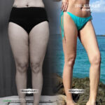Liposuction, Sculpting,Xshape,Lipo, ศัลยกรรมดูดไขมัน, ดูดไขมัน,คลินิกดูดไขมัน,ดูดไขมันเฉพาะส่วน,ดูดไขมันเหนียง,ดูดไขมันหน้าท้อง,ดูดไขมันรีวิว, รีวิวดูดไขมัน, รีวิวดูดไขมันหน้าท้อง,ดูดไขมันต้นแขน, ดูดไขมันต้นขา,ดูดไขมันน่อง, ลดความอ้วน, ดูดไขมันที่ไหนดี, ดูดไขมันราคา, ดูดไขมันทั้งตัว, รีวิว ดูดไขมันต้นขา, ดูดไขมันขา