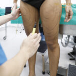 Liposuction, Sculpting,Xshape,Lipo, ศัลยกรรมดูดไขมัน, ดูดไขมัน,คลินิกดูดไขมัน,ดูดไขมันเฉพาะส่วน,ดูดไขมันเหนียง,ดูดไขมันหน้าท้อง,ดูดไขมันรีวิว, รีวิวดูดไขมัน, รีวิวดูดไขมันหน้าท้อง,ดูดไขมันต้นแขน, ดูดไขมันต้นขา,ดูดไขมันน่อง, ลดความอ้วน, ดูดไขมันที่ไหนดี, ดูดไขมันราคา, ดูดไขมันทั้งตัว, รีวิว ดูดไขมันต้นขา, ดูดไขมันขา
