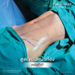 Liposuction, Sculpting,Xshape,Lipo, ศัลยกรรมดูดไขมัน, ดูดไขมัน,คลินิกดูดไขมัน,ดูดไขมันเฉพาะส่วน,ดูดไขมันเหนียง,ดูดไขมันหน้าท้อง,ดูดไขมันรีวิว, รีวิวดูดไขมัน, รีวิวดูดไขมันหน้าท้อง,ดูดไขมันต้นแขน, ดูดไขมันต้นขา,ดูดไขมันน่อง, ลดความอ้วน, ดูดไขมันที่ไหนดี, ดูดไขมันราคา, ดูดไขมันทั้งตัว, รีวิว ดูดไขมันต้นขา, ดูดไขมันขา
