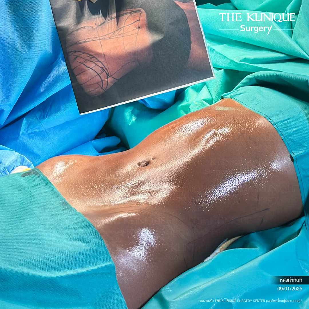 Liposuction, Sculpting,Xshape,Lipo, ศัลยกรรมดูดไขมัน, ดูดไขมัน,คลินิกดูดไขมัน,ดูดไขมันเฉพาะส่วน,ดูดไขมันเหนียง,ดูดไขมันหน้าท้อง,ดูดไขมันรีวิว, รีวิวดูดไขมัน, รีวิวดูดไขมันหน้าท้อง,ดูดไขมันต้นแขน, ดูดไขมันต้นขา,ดูดไขมันน่อง, ลดความอ้วน, ดูดไขมันที่ไหนดี, ดูดไขมันราคา, ดูดไขมันทั้งตัว, รีวิว ดูดไขมันต้นขา, ดูดไขมันขา