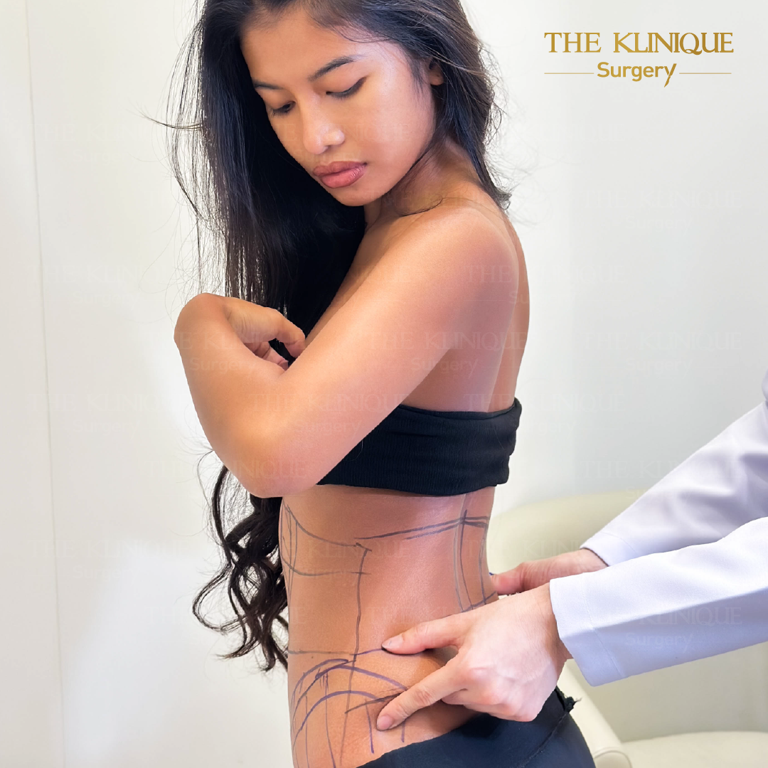 Liposuction, Sculpting,Xshape,Lipo, ศัลยกรรมดูดไขมัน, ดูดไขมัน,คลินิกดูดไขมัน,ดูดไขมันเฉพาะส่วน,ดูดไขมันเหนียง,ดูดไขมันหน้าท้อง,ดูดไขมันรีวิว, รีวิวดูดไขมัน, รีวิวดูดไขมันหน้าท้อง,ดูดไขมันต้นแขน, ดูดไขมันต้นขา,ดูดไขมันน่อง, ลดความอ้วน, ดูดไขมันที่ไหนดี, ดูดไขมันราคา, ดูดไขมันทั้งตัว, รีวิว ดูดไขมันต้นขา, ดูดไขมันขา