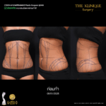Liposuction, Sculpting,Xshape,Lipo, ศัลยกรรมดูดไขมัน, ดูดไขมัน,คลินิกดูดไขมัน,ดูดไขมันเฉพาะส่วน,ดูดไขมันเหนียง,ดูดไขมันหน้าท้อง,ดูดไขมันรีวิว, รีวิวดูดไขมัน, รีวิวดูดไขมันหน้าท้อง,ดูดไขมันต้นแขน, ดูดไขมันต้นขา,ดูดไขมันน่อง, ลดความอ้วน, ดูดไขมันที่ไหนดี, ดูดไขมันราคา, ดูดไขมันทั้งตัว, รีวิว ดูดไขมันต้นขา, ดูดไขมันขา