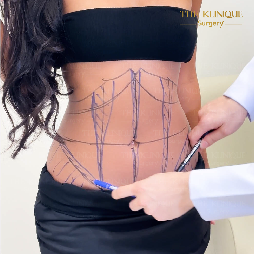 Liposuction, Sculpting,Xshape,Lipo, ศัลยกรรมดูดไขมัน, ดูดไขมัน,คลินิกดูดไขมัน,ดูดไขมันเฉพาะส่วน,ดูดไขมันเหนียง,ดูดไขมันหน้าท้อง,ดูดไขมันรีวิว, รีวิวดูดไขมัน, รีวิวดูดไขมันหน้าท้อง,ดูดไขมันต้นแขน, ดูดไขมันต้นขา,ดูดไขมันน่อง, ลดความอ้วน, ดูดไขมันที่ไหนดี, ดูดไขมันราคา, ดูดไขมันทั้งตัว, รีวิว ดูดไขมันต้นขา, ดูดไขมันขา