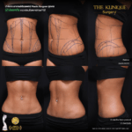 Liposuction, Sculpting,Xshape,Lipo, ศัลยกรรมดูดไขมัน, ดูดไขมัน,คลินิกดูดไขมัน,ดูดไขมันเฉพาะส่วน,ดูดไขมันเหนียง,ดูดไขมันหน้าท้อง,ดูดไขมันรีวิว, รีวิวดูดไขมัน, รีวิวดูดไขมันหน้าท้อง,ดูดไขมันต้นแขน, ดูดไขมันต้นขา,ดูดไขมันน่อง, ลดความอ้วน, ดูดไขมันที่ไหนดี, ดูดไขมันราคา, ดูดไขมันทั้งตัว, รีวิว ดูดไขมันต้นขา, ดูดไขมันขา
