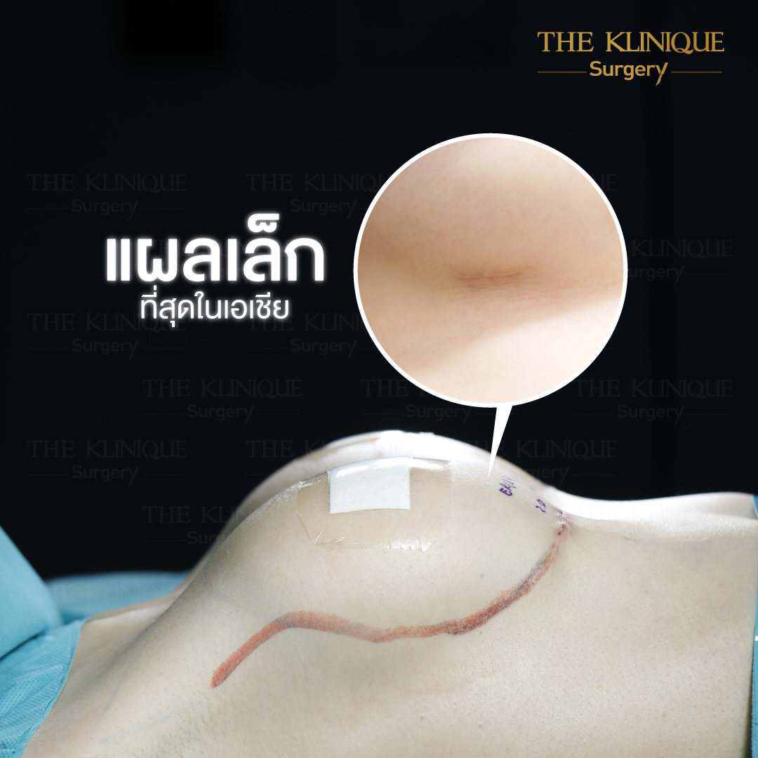เสริมหน้าอก, ศัลยกรรมหน้าอก, เสริมหน้าอกที่ไหนดี, แก้หน้าอก, ทำนม, ซิลิโคนหน้าอก, ทำหน้าอก, เสริมหน้าอก, ศัลยกรรมหน้าหน้าอก, แก้หน้าอกที่ไหนดี, เสริมหน้าอกราคา, แก้หน้าอก ราคา, รีวิวแก้หน้าอก, รีวิวเสริมหน้าอก, แก้หน้าอกไม่เท่ากัน, ทำหน้าอก