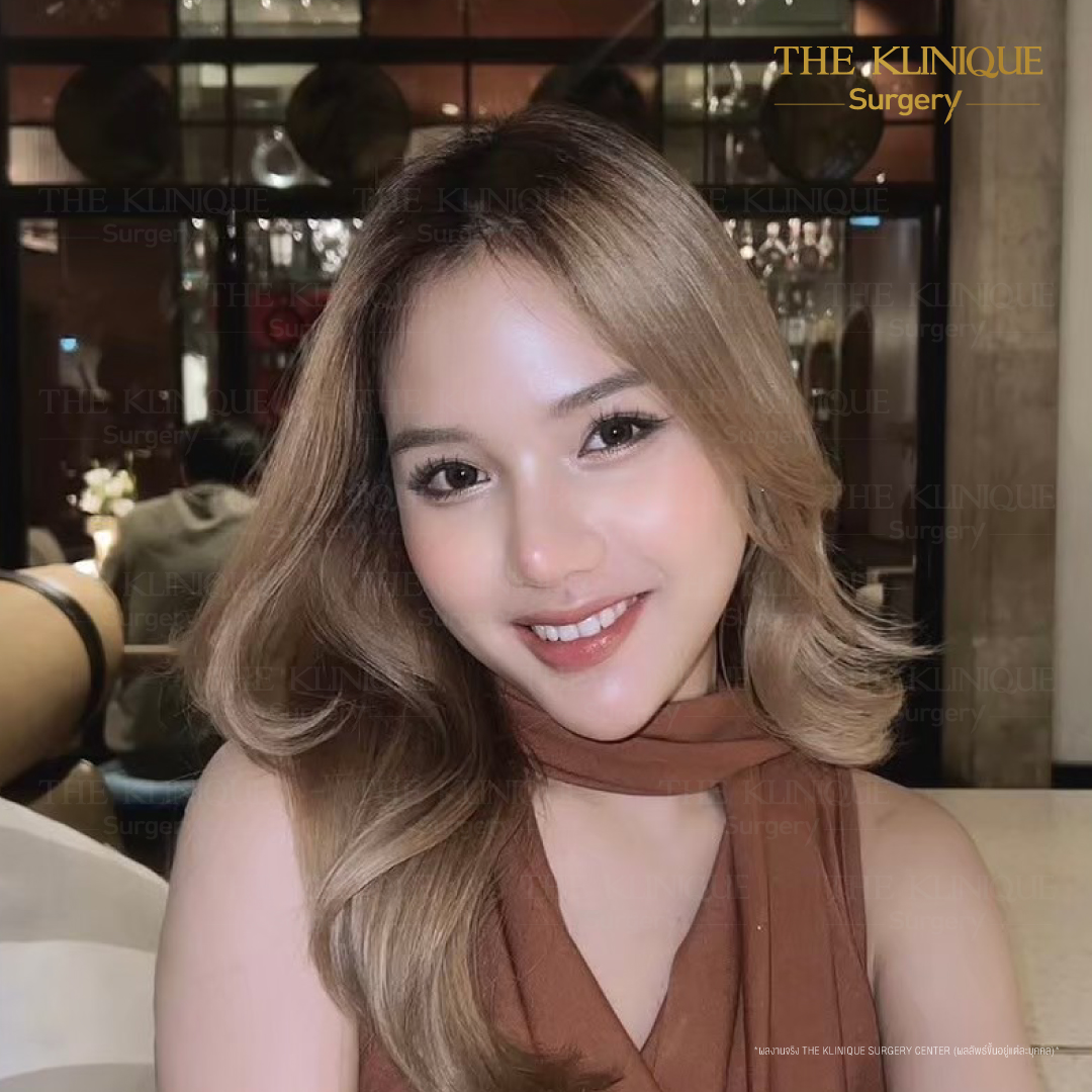 เสริมจมูก, ศัลยกรรมจมูก, ศัลยกรรมจมูก รีวิว, รีวิว เสริมจมูก, ศัลยกรรมจมูกมีกี่แบบ, เสริมจมูกที่ไหนดี, เสริมจมูกโอเพ่น, เสริมจมูกราคา, รีวิวเสริมจมูก, ทำจมูก, ทำจมูก รีวิว, รีวิวทำจมูก, รีวิว ศัลยกรรมจมูก, ซิลิโคนจมูก, แก้จมูก, แก้จมูก รีวิว, รีวิวแก้จมูก, แก้จมูกที่ไหนดี, เสริมจมูก Close, เสริมจมูก semi open, จมูก open, เสริมจมูก Open ที่ไหนดี, รีวิว เสริมจมูก Open, เสริมจมูกโอเพ่น, เสริมจมูกโอเพ่นที่ไหนดี, ทรงจมูก, ทรงจมูกสวย, ทรงจมูกเกาหลี, ทรงจมูกธรรมชาติ, ทรงจมูกสโลปปลายพุ่ง, ทรงจมูกผู้ชาย