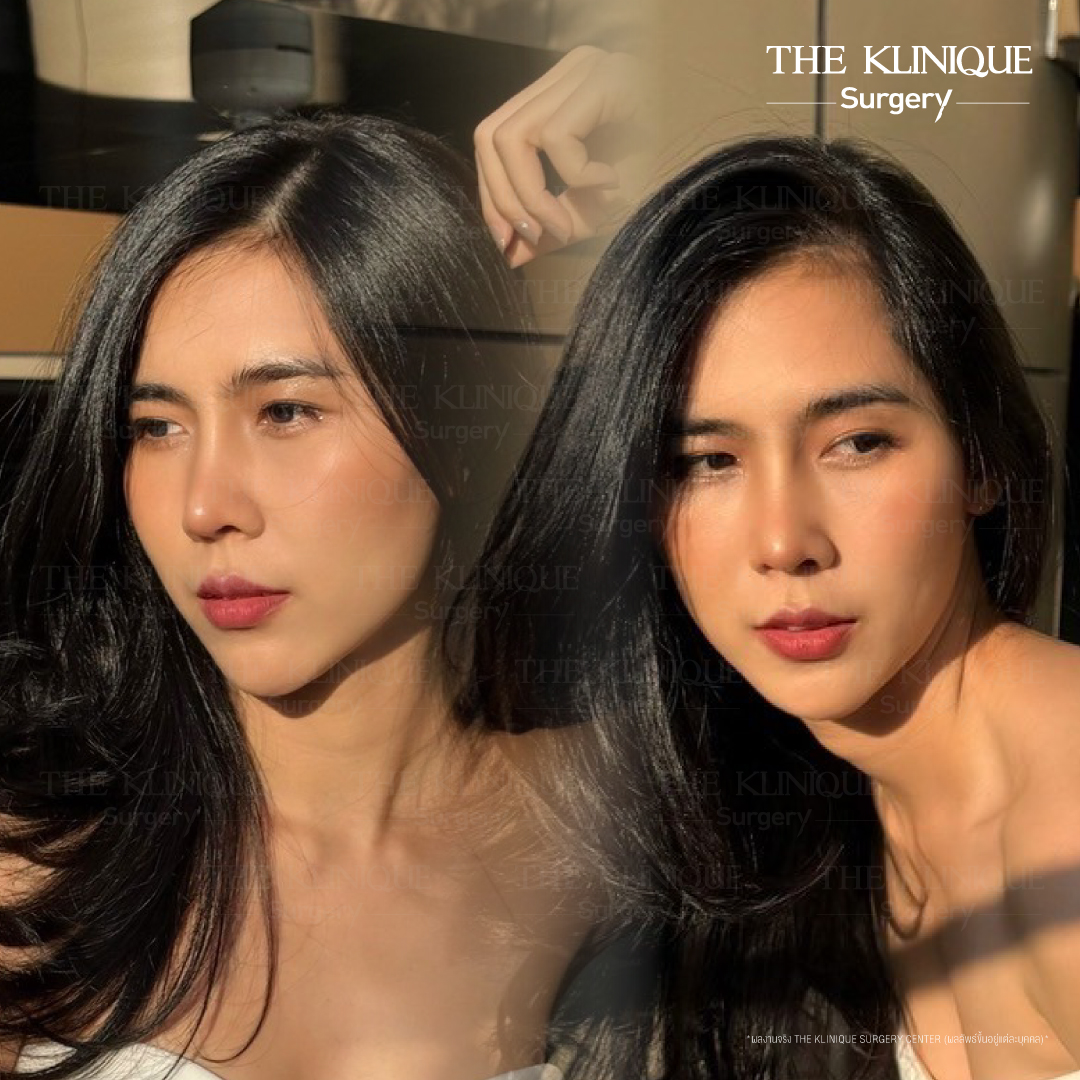 เสริมจมูก, ศัลยกรรมจมูก, ศัลยกรรมจมูก รีวิว, รีวิว เสริมจมูก, ศัลยกรรมจมูกมีกี่แบบ, เสริมจมูกที่ไหนดี, เสริมจมูกโอเพ่น, เสริมจมูกราคา, รีวิวเสริมจมูก, ทำจมูก, ทำจมูก รีวิว, รีวิวทำจมูก, รีวิว ศัลยกรรมจมูก, ซิลิโคนจมูก, แก้จมูก, แก้จมูก รีวิว, รีวิวแก้จมูก, แก้จมูกที่ไหนดี, เสริมจมูก Close, เสริมจมูก semi open, จมูก open, เสริมจมูก Open ที่ไหนดี, รีวิว เสริมจมูก Open, เสริมจมูกโอเพ่น, เสริมจมูกโอเพ่นที่ไหนดี, ทรงจมูก, ทรงจมูกสวย, ทรงจมูกเกาหลี, ทรงจมูกธรรมชาติ, ทรงจมูกสโลปปลายพุ่ง, ทรงจมูกผู้ชาย