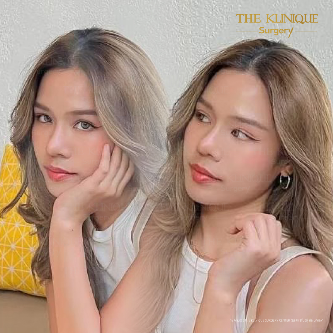 เสริมจมูก, ศัลยกรรมจมูก, ศัลยกรรมจมูก รีวิว, รีวิว เสริมจมูก, ศัลยกรรมจมูกมีกี่แบบ, เสริมจมูกที่ไหนดี, เสริมจมูกโอเพ่น, เสริมจมูกราคา, รีวิวเสริมจมูก, ทำจมูก, ทำจมูก รีวิว, รีวิวทำจมูก, รีวิว ศัลยกรรมจมูก, ซิลิโคนจมูก, แก้จมูก, แก้จมูก รีวิว, รีวิวแก้จมูก, แก้จมูกที่ไหนดี, เสริมจมูก Close, เสริมจมูก semi open, จมูก open, เสริมจมูก Open ที่ไหนดี, รีวิว เสริมจมูก Open, เสริมจมูกโอเพ่น, เสริมจมูกโอเพ่นที่ไหนดี, ทรงจมูก, ทรงจมูกสวย, ทรงจมูกเกาหลี, ทรงจมูกธรรมชาติ, ทรงจมูกสโลปปลายพุ่ง, ทรงจมูกผู้ชาย