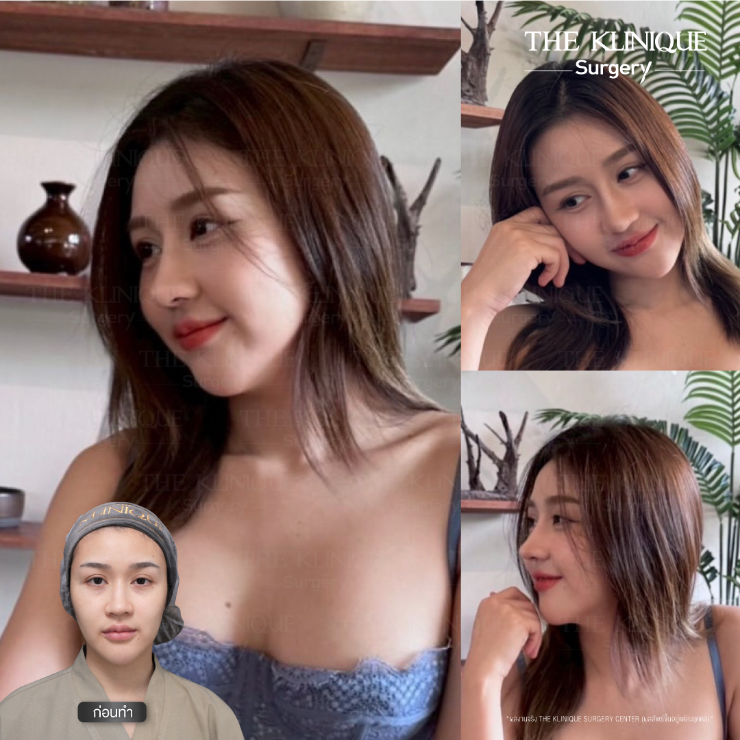 เสริมจมูก, ศัลยกรรมจมูก, ศัลยกรรมจมูก รีวิว, รีวิว เสริมจมูก, ศัลยกรรมจมูกมีกี่แบบ, เสริมจมูกที่ไหนดี, เสริมจมูกโอเพ่น, เสริมจมูกราคา, รีวิวเสริมจมูก, ทำจมูก, ทำจมูก รีวิว, รีวิวทำจมูก, รีวิว ศัลยกรรมจมูก, ซิลิโคนจมูก, แก้จมูก, แก้จมูก รีวิว, รีวิวแก้จมูก, แก้จมูกที่ไหนดี, เสริมจมูก Close, เสริมจมูก semi open, จมูก open, เสริมจมูก Open ที่ไหนดี, รีวิว เสริมจมูก Open, เสริมจมูกโอเพ่น, เสริมจมูกโอเพ่นที่ไหนดี, ทรงจมูก, ทรงจมูกสวย, ทรงจมูกเกาหลี, ทรงจมูกธรรมชาติ, ทรงจมูกสโลปปลายพุ่ง, ทรงจมูกผู้ชาย