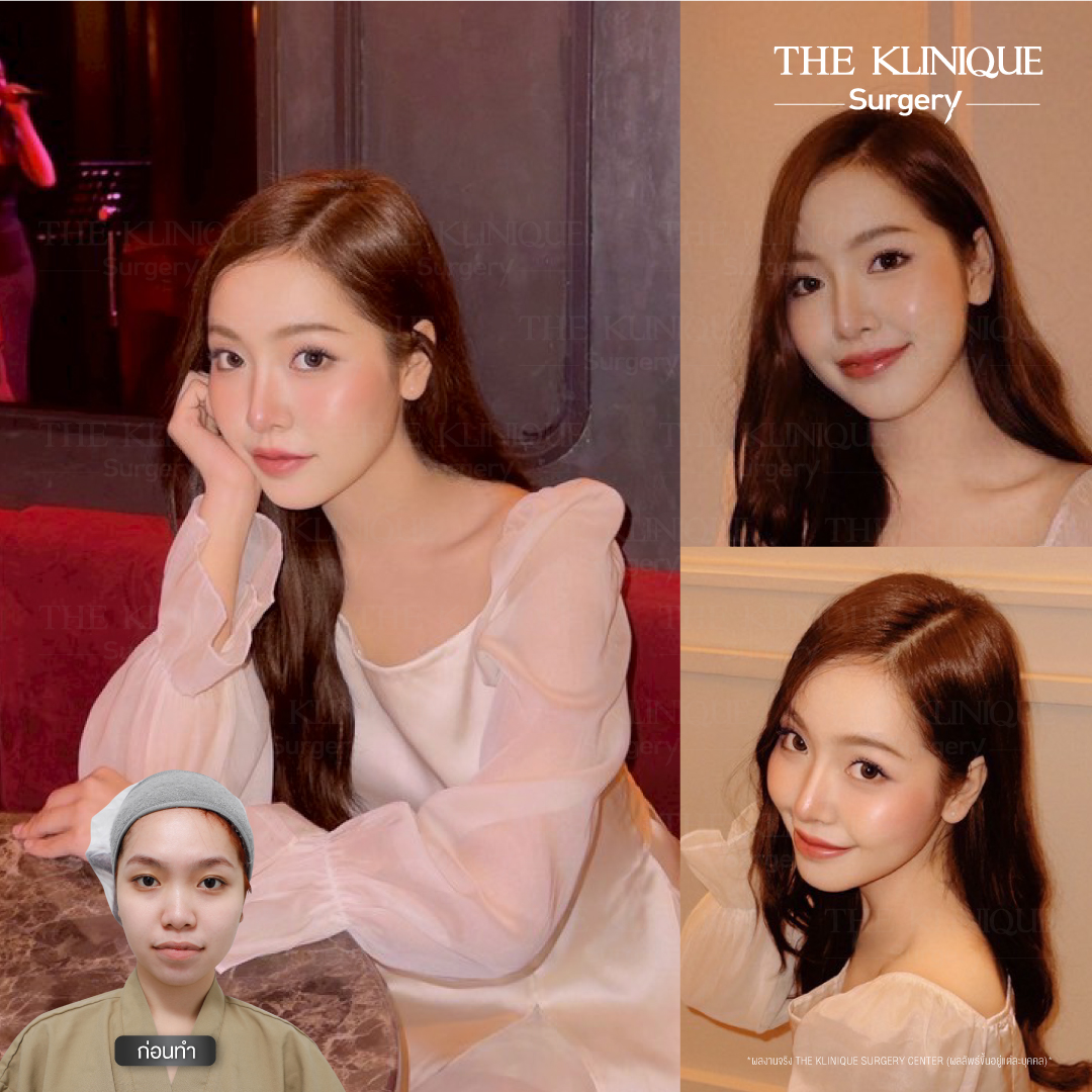 เสริมจมูก, ศัลยกรรมจมูก, ศัลยกรรมจมูก รีวิว, รีวิว เสริมจมูก, ศัลยกรรมจมูกมีกี่แบบ, เสริมจมูกที่ไหนดี, เสริมจมูกโอเพ่น, เสริมจมูกราคา, รีวิวเสริมจมูก, ทำจมูก, ทำจมูก รีวิว, รีวิวทำจมูก, รีวิว ศัลยกรรมจมูก, ซิลิโคนจมูก, แก้จมูก, แก้จมูก รีวิว, รีวิวแก้จมูก, แก้จมูกที่ไหนดี, เสริมจมูก Close, เสริมจมูก semi open, จมูก open, เสริมจมูก Open ที่ไหนดี, รีวิว เสริมจมูก Open, เสริมจมูกโอเพ่น, เสริมจมูกโอเพ่นที่ไหนดี, ทรงจมูก, ทรงจมูกสวย, ทรงจมูกเกาหลี, ทรงจมูกธรรมชาติ, ทรงจมูกสโลปปลายพุ่ง, ทรงจมูกผู้ชาย