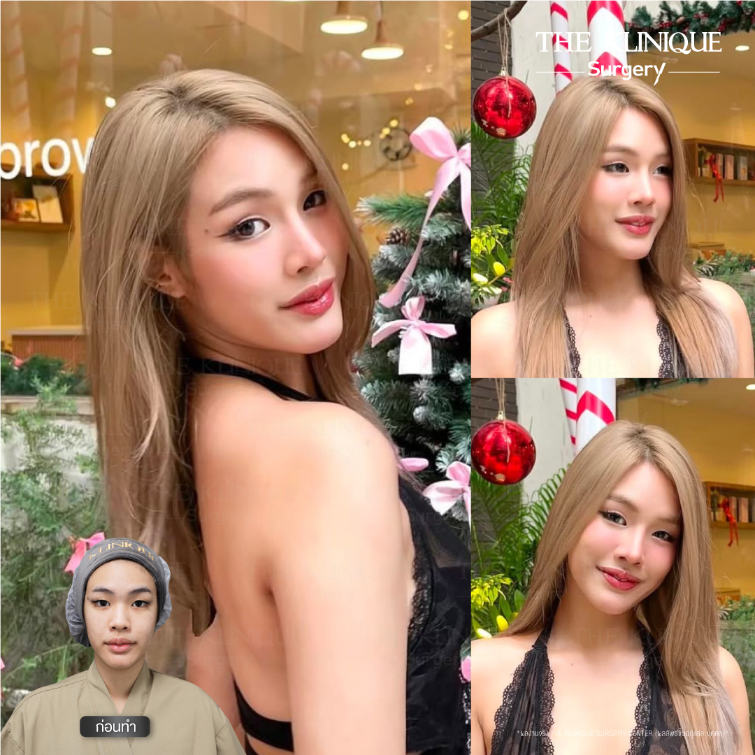 เสริมจมูก, ศัลยกรรมจมูก, ศัลยกรรมจมูก รีวิว, รีวิว เสริมจมูก, ศัลยกรรมจมูกมีกี่แบบ, เสริมจมูกที่ไหนดี, เสริมจมูกโอเพ่น, เสริมจมูกราคา, รีวิวเสริมจมูก, ทำจมูก, ทำจมูก รีวิว, รีวิวทำจมูก, รีวิว ศัลยกรรมจมูก, ซิลิโคนจมูก, แก้จมูก, แก้จมูก รีวิว, รีวิวแก้จมูก, แก้จมูกที่ไหนดี, เสริมจมูก Close, เสริมจมูก semi open, จมูก open, เสริมจมูก Open ที่ไหนดี, รีวิว เสริมจมูก Open, เสริมจมูกโอเพ่น, เสริมจมูกโอเพ่นที่ไหนดี, ทรงจมูก, ทรงจมูกสวย, ทรงจมูกเกาหลี, ทรงจมูกธรรมชาติ, ทรงจมูกสโลปปลายพุ่ง, ทรงจมูกผู้ชาย