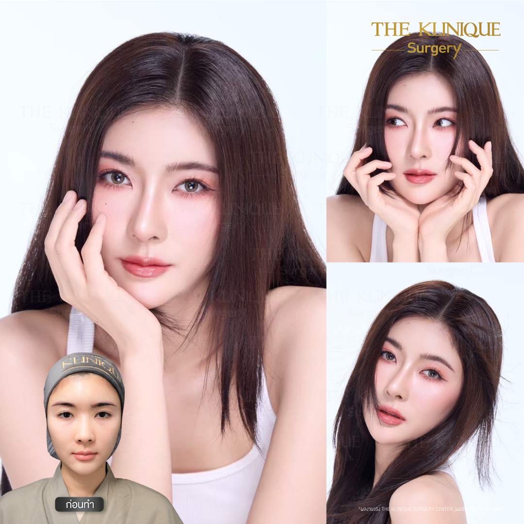 เสริมจมูก, ศัลยกรรมจมูก, ศัลยกรรมจมูก รีวิว, รีวิว เสริมจมูก, ศัลยกรรมจมูกมีกี่แบบ, เสริมจมูกที่ไหนดี, เสริมจมูกโอเพ่น, เสริมจมูกราคา, รีวิวเสริมจมูก, ทำจมูก, ทำจมูก รีวิว, รีวิวทำจมูก, รีวิว ศัลยกรรมจมูก, ซิลิโคนจมูก, แก้จมูก, แก้จมูก รีวิว, รีวิวแก้จมูก, แก้จมูกที่ไหนดี, เสริมจมูก Close, เสริมจมูก semi open, จมูก open, เสริมจมูก Open ที่ไหนดี, รีวิว เสริมจมูก Open, เสริมจมูกโอเพ่น, เสริมจมูกโอเพ่นที่ไหนดี, ทรงจมูก, ทรงจมูกสวย, ทรงจมูกเกาหลี, ทรงจมูกธรรมชาติ, ทรงจมูกสโลปปลายพุ่ง, ทรงจมูกผู้ชาย