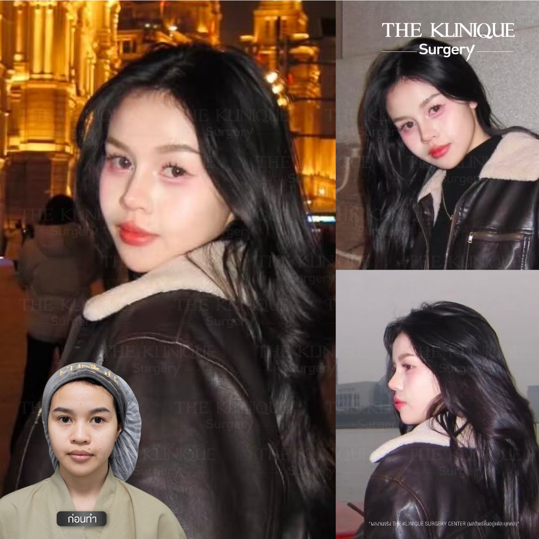 เสริมจมูก, ศัลยกรรมจมูก, ศัลยกรรมจมูก รีวิว, รีวิว เสริมจมูก, ศัลยกรรมจมูกมีกี่แบบ, เสริมจมูกที่ไหนดี, เสริมจมูกโอเพ่น, เสริมจมูกราคา, รีวิวเสริมจมูก, ทำจมูก, ทำจมูก รีวิว, รีวิวทำจมูก, รีวิว ศัลยกรรมจมูก, ซิลิโคนจมูก, แก้จมูก, แก้จมูก รีวิว, รีวิวแก้จมูก, แก้จมูกที่ไหนดี, เสริมจมูก Close, เสริมจมูก semi open, จมูก open, เสริมจมูก Open ที่ไหนดี, รีวิว เสริมจมูก Open, เสริมจมูกโอเพ่น, เสริมจมูกโอเพ่นที่ไหนดี, ทรงจมูก, ทรงจมูกสวย, ทรงจมูกเกาหลี, ทรงจมูกธรรมชาติ, ทรงจมูกสโลปปลายพุ่ง, ทรงจมูกผู้ชาย