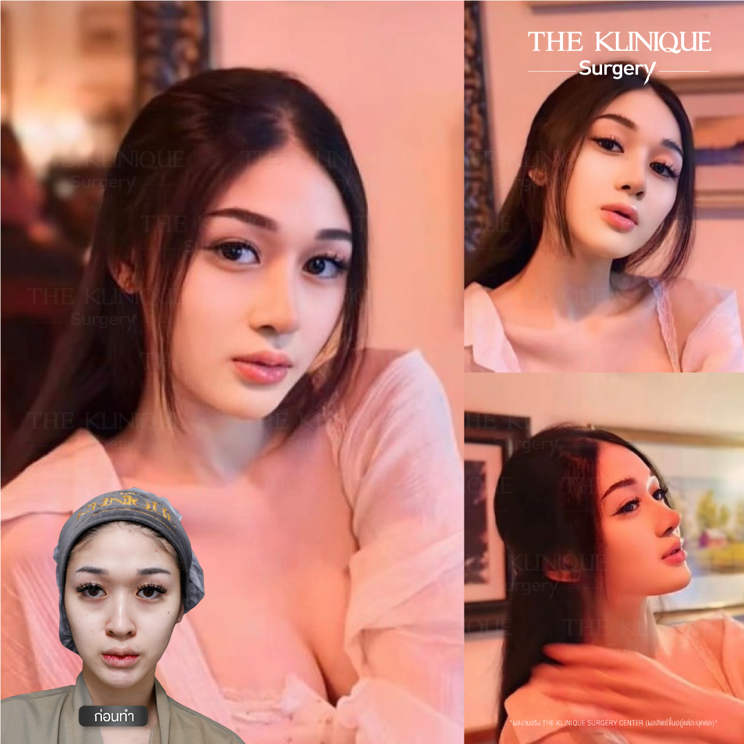เสริมจมูก, ศัลยกรรมจมูก, ศัลยกรรมจมูก รีวิว, รีวิว เสริมจมูก, ศัลยกรรมจมูกมีกี่แบบ, เสริมจมูกที่ไหนดี, เสริมจมูกโอเพ่น, เสริมจมูกราคา, รีวิวเสริมจมูก, ทำจมูก, ทำจมูก รีวิว, รีวิวทำจมูก, รีวิว ศัลยกรรมจมูก, ซิลิโคนจมูก, แก้จมูก, แก้จมูก รีวิว, รีวิวแก้จมูก, แก้จมูกที่ไหนดี, เสริมจมูก Close, เสริมจมูก semi open, จมูก open, เสริมจมูก Open ที่ไหนดี, รีวิว เสริมจมูก Open, เสริมจมูกโอเพ่น, เสริมจมูกโอเพ่นที่ไหนดี, ทรงจมูก, ทรงจมูกสวย, ทรงจมูกเกาหลี, ทรงจมูกธรรมชาติ, ทรงจมูกสโลปปลายพุ่ง, ทรงจมูกผู้ชาย