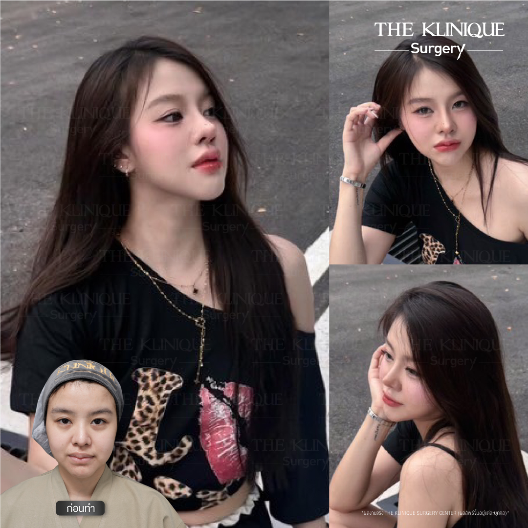 เสริมจมูก, ศัลยกรรมจมูก, ศัลยกรรมจมูก รีวิว, รีวิว เสริมจมูก, ศัลยกรรมจมูกมีกี่แบบ, เสริมจมูกที่ไหนดี, เสริมจมูกโอเพ่น, เสริมจมูกราคา, รีวิวเสริมจมูก, ทำจมูก, ทำจมูก รีวิว, รีวิวทำจมูก, รีวิว ศัลยกรรมจมูก, ซิลิโคนจมูก, แก้จมูก, แก้จมูก รีวิว, รีวิวแก้จมูก, แก้จมูกที่ไหนดี, เสริมจมูก Close, เสริมจมูก semi open, จมูก open, เสริมจมูก Open ที่ไหนดี, รีวิว เสริมจมูก Open, เสริมจมูกโอเพ่น, เสริมจมูกโอเพ่นที่ไหนดี, ทรงจมูก, ทรงจมูกสวย, ทรงจมูกเกาหลี, ทรงจมูกธรรมชาติ, ทรงจมูกสโลปปลายพุ่ง, ทรงจมูกผู้ชาย