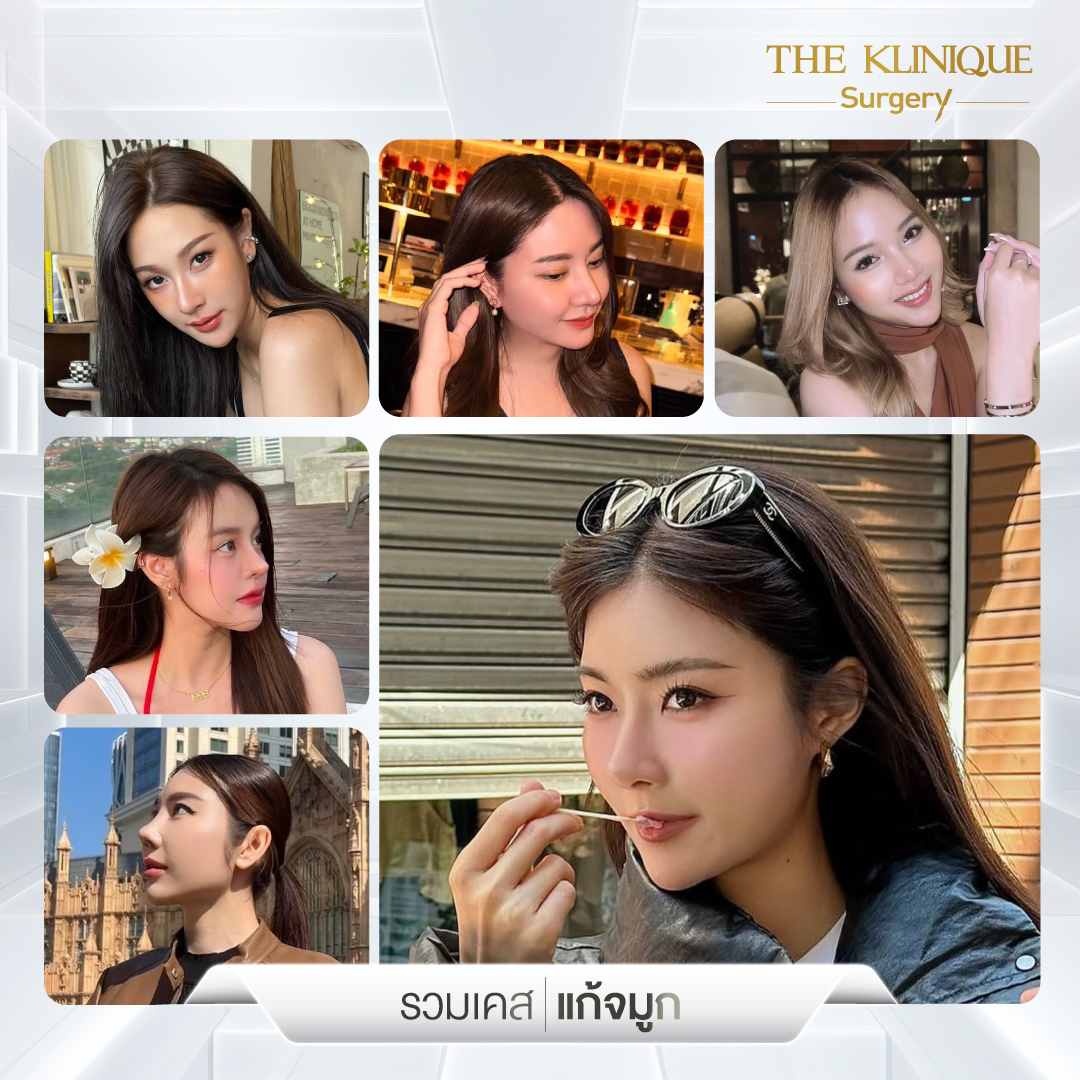 เสริมจมูก, ศัลยกรรมจมูก, ศัลยกรรมจมูก รีวิว, รีวิว เสริมจมูก, ศัลยกรรมจมูกมีกี่แบบ, เสริมจมูกที่ไหนดี, เสริมจมูกโอเพ่น, เสริมจมูกราคา, รีวิวเสริมจมูก, ทำจมูก, ทำจมูก รีวิว, รีวิวทำจมูก, รีวิว ศัลยกรรมจมูก, ซิลิโคนจมูก, แก้จมูก, แก้จมูก รีวิว, รีวิวแก้จมูก, แก้จมูกที่ไหนดี, เสริมจมูก Close, เสริมจมูก semi open, จมูก open, เสริมจมูก Open ที่ไหนดี, รีวิว เสริมจมูก Open, เสริมจมูกโอเพ่น, เสริมจมูกโอเพ่นที่ไหนดี, ทรงจมูก, ทรงจมูกสวย, ทรงจมูกเกาหลี, ทรงจมูกธรรมชาติ, ทรงจมูกสโลปปลายพุ่ง, ทรงจมูกผู้ชาย
