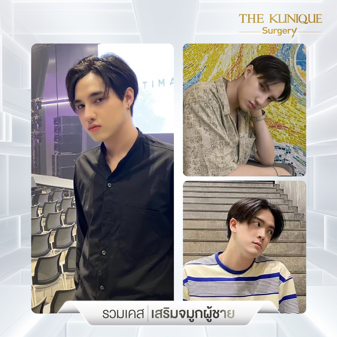 เสริมจมูก, ศัลยกรรมจมูก, ศัลยกรรมจมูก รีวิว, รีวิว เสริมจมูก, ศัลยกรรมจมูกมีกี่แบบ, เสริมจมูกที่ไหนดี, เสริมจมูกโอเพ่น, เสริมจมูกราคา, รีวิวเสริมจมูก, ทำจมูก, ทำจมูก รีวิว, รีวิวทำจมูก, รีวิว ศัลยกรรมจมูก, ซิลิโคนจมูก, แก้จมูก, แก้จมูก รีวิว, รีวิวแก้จมูก, แก้จมูกที่ไหนดี, เสริมจมูก Close, เสริมจมูก semi open, จมูก open, เสริมจมูก Open ที่ไหนดี, รีวิว เสริมจมูก Open, เสริมจมูกโอเพ่น, เสริมจมูกโอเพ่นที่ไหนดี, ทรงจมูก, ทรงจมูกสวย, ทรงจมูกเกาหลี, ทรงจมูกธรรมชาติ, ทรงจมูกสโลปปลายพุ่ง, ทรงจมูกผู้ชาย
