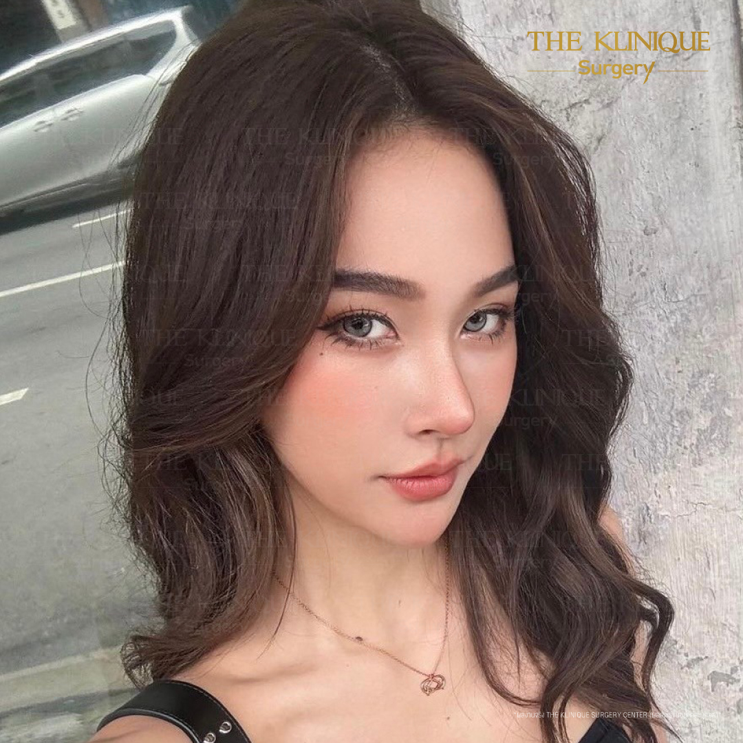 เสริมจมูก, ศัลยกรรมจมูก, ศัลยกรรมจมูก รีวิว, รีวิว เสริมจมูก, ศัลยกรรมจมูกมีกี่แบบ, เสริมจมูกที่ไหนดี, เสริมจมูกโอเพ่น, เสริมจมูกราคา, รีวิวเสริมจมูก, ทำจมูก, ทำจมูก รีวิว, รีวิวทำจมูก, รีวิว ศัลยกรรมจมูก, ซิลิโคนจมูก, แก้จมูก, แก้จมูก รีวิว, รีวิวแก้จมูก, แก้จมูกที่ไหนดี, เสริมจมูก Close, เสริมจมูก semi open, จมูก open, เสริมจมูก Open ที่ไหนดี, รีวิว เสริมจมูก Open, เสริมจมูกโอเพ่น, เสริมจมูกโอเพ่นที่ไหนดี, ทรงจมูก, ทรงจมูกสวย, ทรงจมูกเกาหลี, ทรงจมูกธรรมชาติ, ทรงจมูกสโลปปลายพุ่ง, ทรงจมูกผู้ชาย