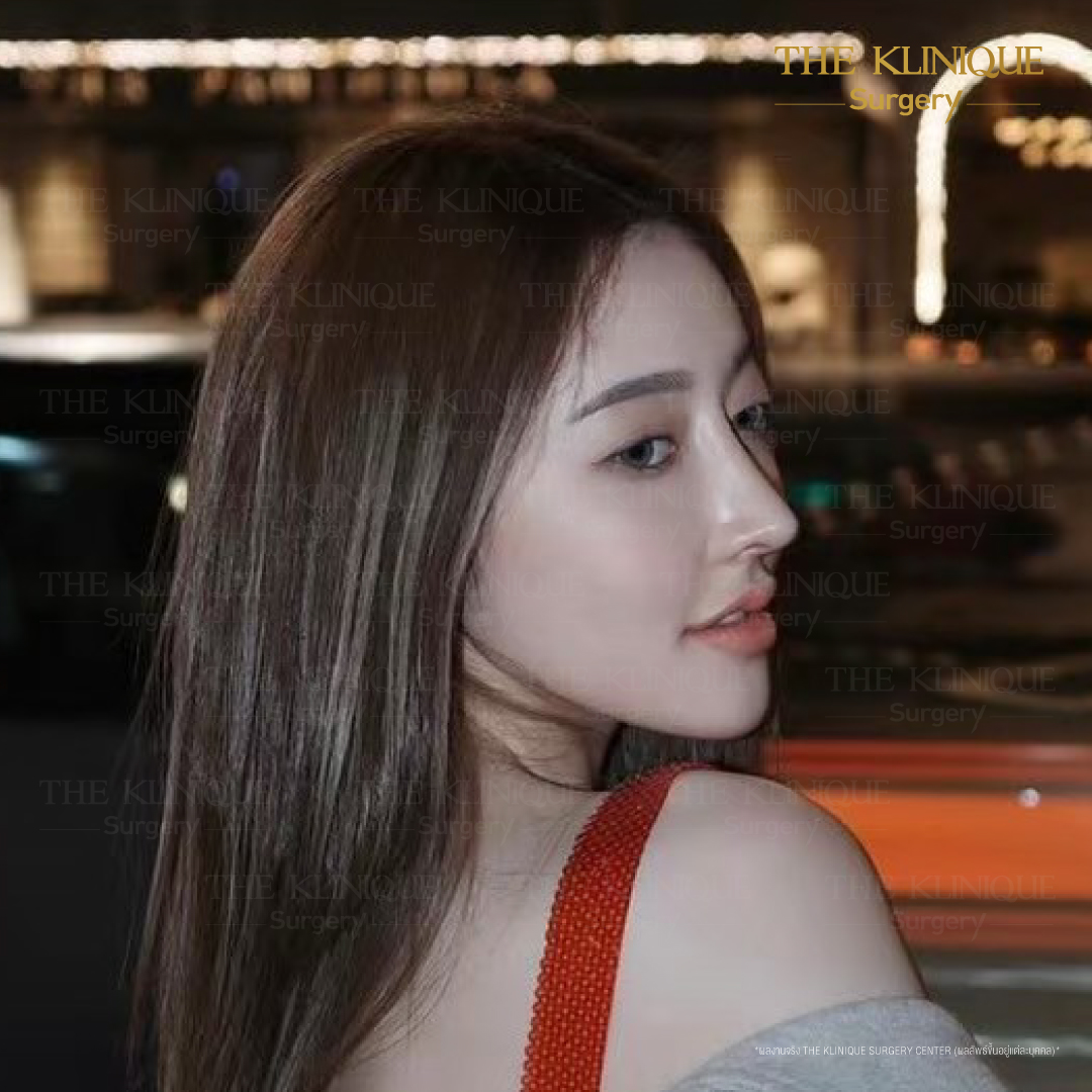 เสริมจมูก, ศัลยกรรมจมูก, ศัลยกรรมจมูก รีวิว, รีวิว เสริมจมูก, ศัลยกรรมจมูกมีกี่แบบ, เสริมจมูกที่ไหนดี, เสริมจมูกโอเพ่น, เสริมจมูกราคา, รีวิวเสริมจมูก, ทำจมูก, ทำจมูก รีวิว, รีวิวทำจมูก, รีวิว ศัลยกรรมจมูก, ซิลิโคนจมูก, แก้จมูก, แก้จมูก รีวิว, รีวิวแก้จมูก, แก้จมูกที่ไหนดี, เสริมจมูก Close, เสริมจมูก semi open, จมูก open, เสริมจมูก Open ที่ไหนดี, รีวิว เสริมจมูก Open, เสริมจมูกโอเพ่น, เสริมจมูกโอเพ่นที่ไหนดี, ทรงจมูก, ทรงจมูกสวย, ทรงจมูกเกาหลี, ทรงจมูกธรรมชาติ, ทรงจมูกสโลปปลายพุ่ง, ทรงจมูกผู้ชาย