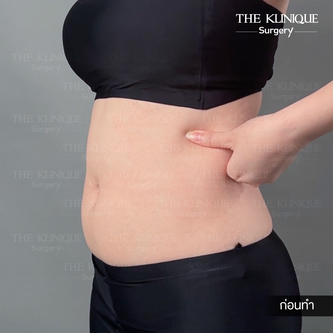 Liposuction, Sculpting,Xshape,Lipo, ศัลยกรรมดูดไขมัน, ดูดไขมัน,คลินิกดูดไขมัน,ดูดไขมันเฉพาะส่วน,ดูดไขมันเหนียง,ดูดไขมันหน้าท้อง,ดูดไขมันรีวิว, รีวิวดูดไขมัน, รีวิวดูดไขมันหน้าท้อง,ดูดไขมันต้นแขน, ดูดไขมันต้นขา,ดูดไขมันน่อง, ลดความอ้วน, ดูดไขมันที่ไหนดี, ดูดไขมันราคา, ดูดไขมันทั้งตัว, รีวิว ดูดไขมันต้นขา, ดูดไขมันขา
