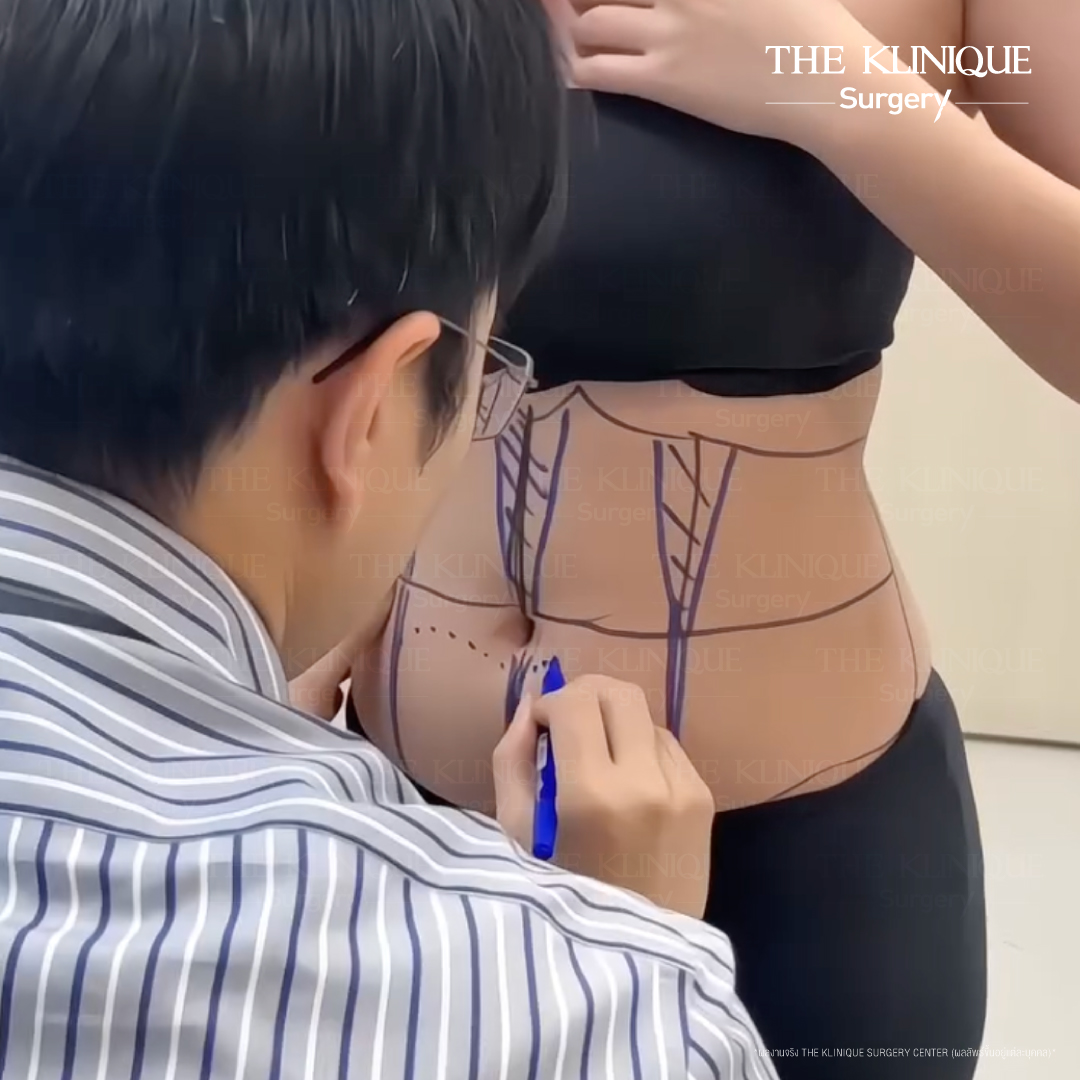 Liposuction, Sculpting,Xshape,Lipo, ศัลยกรรมดูดไขมัน, ดูดไขมัน,คลินิกดูดไขมัน,ดูดไขมันเฉพาะส่วน,ดูดไขมันเหนียง,ดูดไขมันหน้าท้อง,ดูดไขมันรีวิว, รีวิวดูดไขมัน, รีวิวดูดไขมันหน้าท้อง,ดูดไขมันต้นแขน, ดูดไขมันต้นขา,ดูดไขมันน่อง, ลดความอ้วน, ดูดไขมันที่ไหนดี, ดูดไขมันราคา, ดูดไขมันทั้งตัว, รีวิว ดูดไขมันต้นขา, ดูดไขมันขา