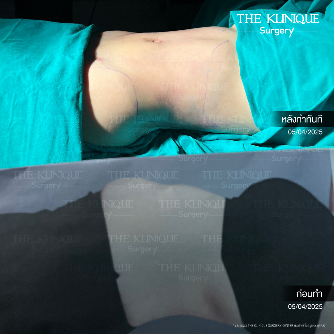Liposuction, Sculpting,Xshape,Lipo, ศัลยกรรมดูดไขมัน, ดูดไขมัน,คลินิกดูดไขมัน,ดูดไขมันเฉพาะส่วน,ดูดไขมันเหนียง,ดูดไขมันหน้าท้อง,ดูดไขมันรีวิว, รีวิวดูดไขมัน, รีวิวดูดไขมันหน้าท้อง,ดูดไขมันต้นแขน, ดูดไขมันต้นขา,ดูดไขมันน่อง, ลดความอ้วน, ดูดไขมันที่ไหนดี, ดูดไขมันราคา, ดูดไขมันทั้งตัว, รีวิว ดูดไขมันต้นขา, ดูดไขมันขา