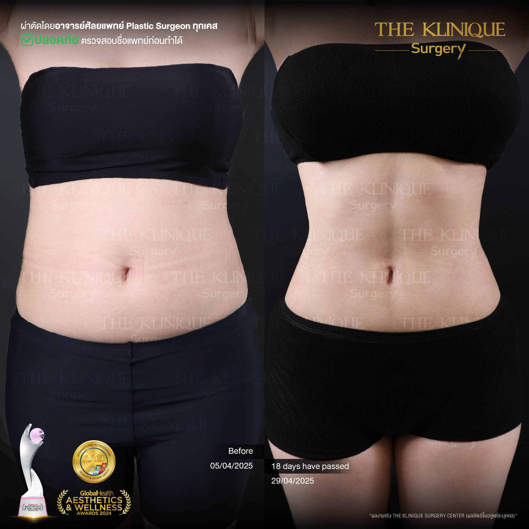 Liposuction, Sculpting,Xshape,Lipo, ศัลยกรรมดูดไขมัน, ดูดไขมัน,คลินิกดูดไขมัน,ดูดไขมันเฉพาะส่วน,ดูดไขมันเหนียง,ดูดไขมันหน้าท้อง,ดูดไขมันรีวิว, รีวิวดูดไขมัน, รีวิวดูดไขมันหน้าท้อง,ดูดไขมันต้นแขน, ดูดไขมันต้นขา,ดูดไขมันน่อง, ลดความอ้วน, ดูดไขมันที่ไหนดี, ดูดไขมันราคา, ดูดไขมันทั้งตัว, รีวิว ดูดไขมันต้นขา, ดูดไขมันขา