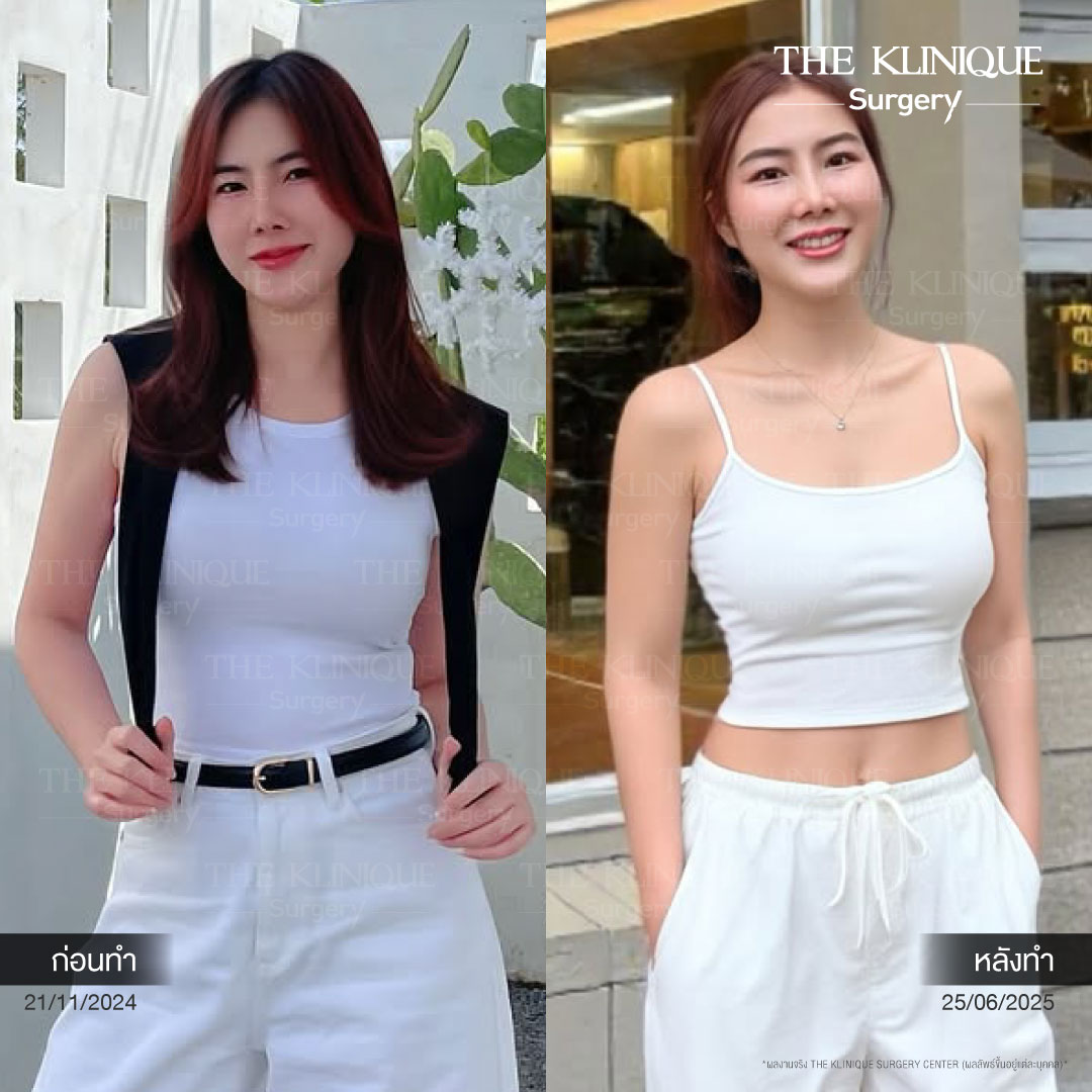 Liposuction, Sculpting,Xshape,Lipo, ศัลยกรรมดูดไขมัน, ดูดไขมัน,คลินิกดูดไขมัน,ดูดไขมันเฉพาะส่วน,ดูดไขมันเหนียง,ดูดไขมันหน้าท้อง,ดูดไขมันรีวิว, รีวิวดูดไขมัน, รีวิวดูดไขมันหน้าท้อง,ดูดไขมันต้นแขน, ดูดไขมันต้นขา,ดูดไขมันน่อง, ลดความอ้วน, ดูดไขมันที่ไหนดี, ดูดไขมันราคา, ดูดไขมันทั้งตัว, รีวิว ดูดไขมันต้นขา, ดูดไขมันขา
