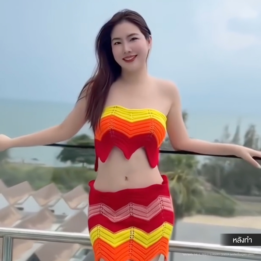 Liposuction, Sculpting,Xshape,Lipo, ศัลยกรรมดูดไขมัน, ดูดไขมัน,คลินิกดูดไขมัน,ดูดไขมันเฉพาะส่วน,ดูดไขมันเหนียง,ดูดไขมันหน้าท้อง,ดูดไขมันรีวิว, รีวิวดูดไขมัน, รีวิวดูดไขมันหน้าท้อง,ดูดไขมันต้นแขน, ดูดไขมันต้นขา,ดูดไขมันน่อง, ลดความอ้วน, ดูดไขมันที่ไหนดี, ดูดไขมันราคา, ดูดไขมันทั้งตัว, รีวิว ดูดไขมันต้นขา, ดูดไขมันขา