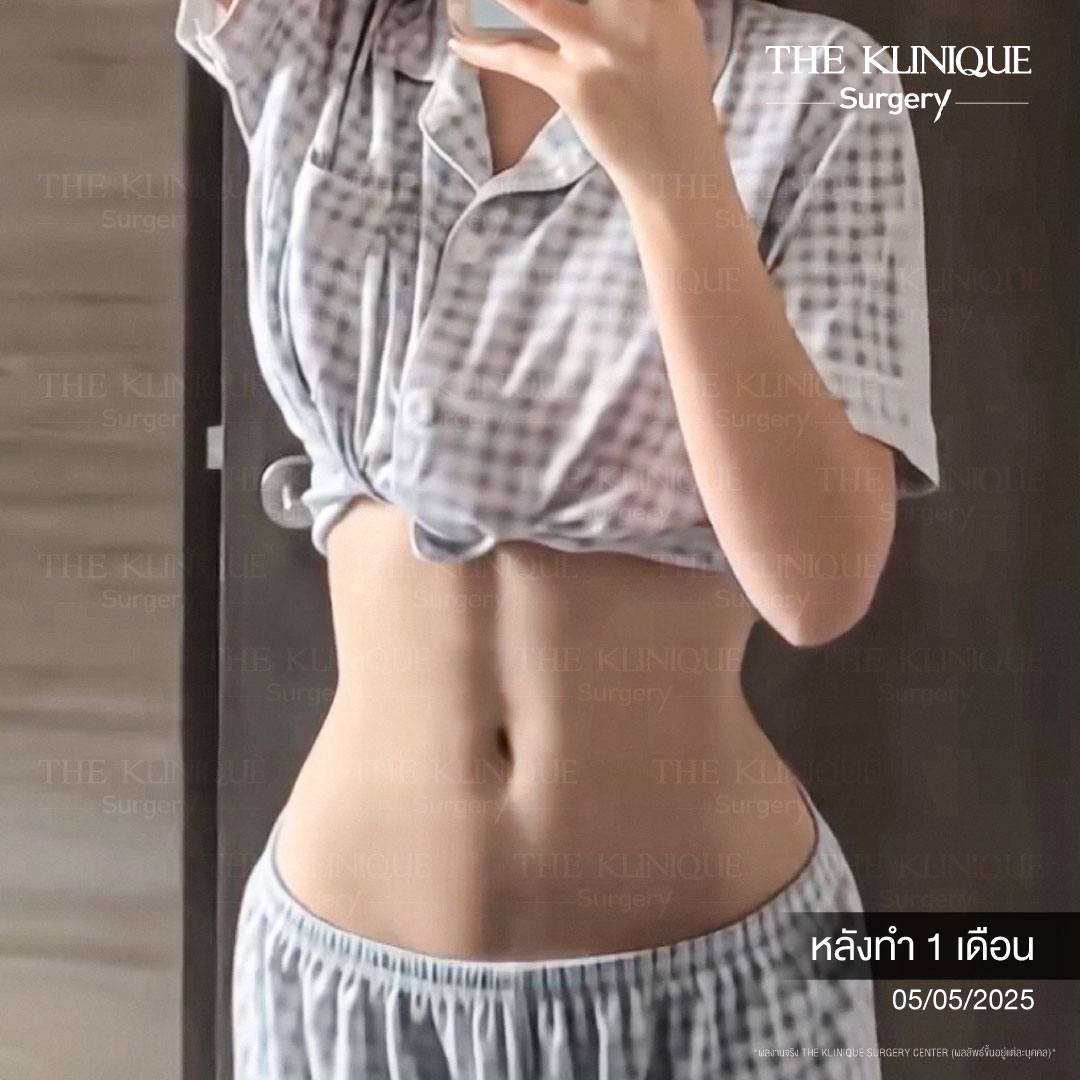 Liposuction, Sculpting,Xshape,Lipo, ศัลยกรรมดูดไขมัน, ดูดไขมัน,คลินิกดูดไขมัน,ดูดไขมันเฉพาะส่วน,ดูดไขมันเหนียง,ดูดไขมันหน้าท้อง,ดูดไขมันรีวิว, รีวิวดูดไขมัน, รีวิวดูดไขมันหน้าท้อง,ดูดไขมันต้นแขน, ดูดไขมันต้นขา,ดูดไขมันน่อง, ลดความอ้วน, ดูดไขมันที่ไหนดี, ดูดไขมันราคา, ดูดไขมันทั้งตัว, รีวิว ดูดไขมันต้นขา, ดูดไขมันขา
