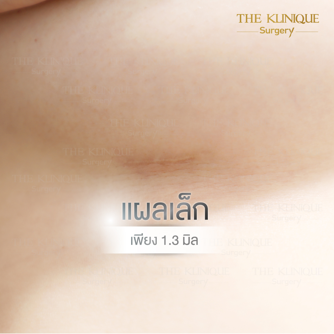 ทำหน้าอก, เสริมหน้าอก, ศัลยกรรมหน้าอก, เสริมหน้าอกที่ไหนดี, แก้หน้าอก, แก้หน้าอกที่ไหนดี, เสริมหน้าอกราคา, แก้หน้าอก ราคา, รีวิวแก้หน้าอก, รีวิวเสริมหน้าอก, แก้หน้าอกไม่เท่ากัน, ทำหน้าอก, ทำนม, ซิลิโคนหน้าอก,เสริมหน้าอก รีวืว, เสริมหน้าอกครั้งแรก, ทำหน้าอก ราคา, หน้าอกไม่เท่ากัน, ซิลิโคนหน้าอกมีกี่แบบ, ซิลิโคนหน้าอก Motiva, ซิลิโคนหน้า Mentor, ยกกระชับหน้าอก, ยกกระชับทรวงอก, ศัลยกรรมกระชับทรวงอก, ทรวหน้าอก, กระชับหน้าอก, ผ่าตัดหน้าอก, เสริมหน้าอกแผลเล็ก, เสริมหน้าอกทรงหยดน้ำ, เสริมหน้าแบบไหนดี, Breast Augmentation, Asia Breast Innovation  