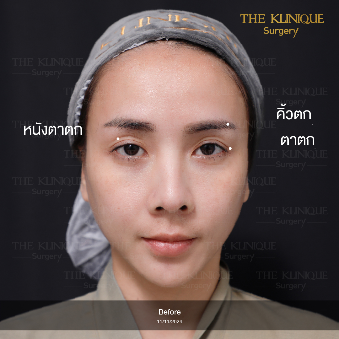 ดึงหน้าดารา, ดึงหน้า, ศัลยกรรมดึงหน้า,ดึงหน้าย้อนวัย, ดึงหน้าที่ไหนดี, ผ่าตัดดึงหน้า, ยกคิ้ว, ยกหางตา, หางตาตก, ดึงหน้าดารา, ดึงหน้ารีวิว, Facelift, Neck lift, Endotine, ยกคิ้ว Endotine,Foxy Eyes, แก้หนังตาตก , แก้ตาไม่เท่ากัน ,หนังตาตก,แก้หนังตาตก,ยกคิ้ว รีวิว, ยกคิ้วส่องกล้อง, ยกคิ้วที่ไหนดี, ยกคิ้ว,ศัลยกรรมยกคิ้ว