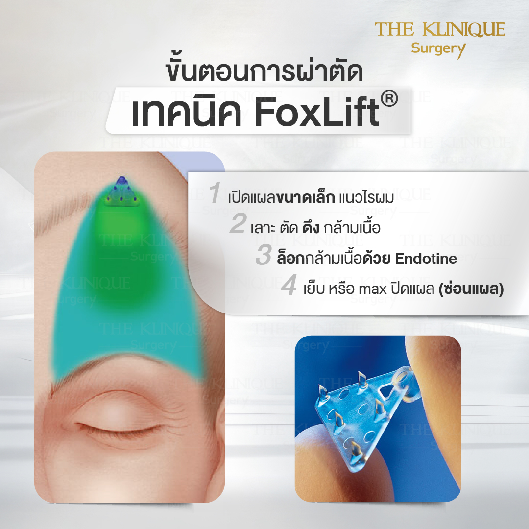 ดึงหน้าดารา, ดึงหน้า, ศัลยกรรมดึงหน้า,ดึงหน้าย้อนวัย, ดึงหน้าที่ไหนดี, ผ่าตัดดึงหน้า, ยกคิ้ว, ยกหางตา, หางตาตก, ดึงหน้าดารา, ดึงหน้ารีวิว, Facelift, Neck lift, Endotine, ยกคิ้ว Endotine,Foxy Eyes, แก้หนังตาตก , แก้ตาไม่เท่ากัน ,หนังตาตก,แก้หนังตาตก,ยกคิ้ว รีวิว, ยกคิ้วส่องกล้อง, ยกคิ้วที่ไหนดี, ยกคิ้ว,ศัลยกรรมยกคิ้ว