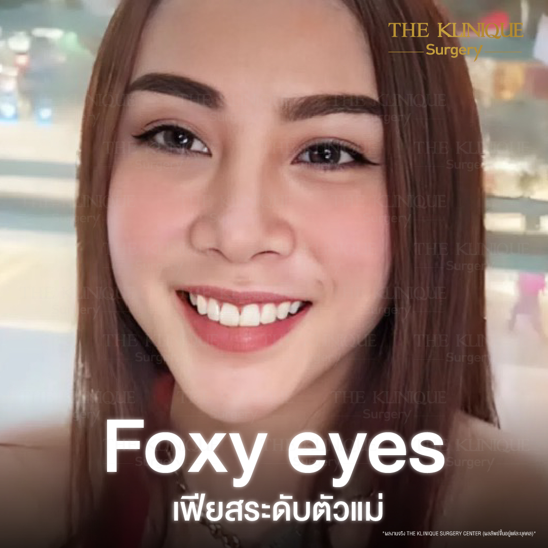 ดึงหน้าดารา, ดึงหน้า, ศัลยกรรมดึงหน้า,ดึงหน้าย้อนวัย, ดึงหน้าที่ไหนดี, ผ่าตัดดึงหน้า, ยกคิ้ว, ยกหางตา, หางตาตก, ดึงหน้าดารา, ดึงหน้ารีวิว, Facelift, Neck lift, Endotine, ยกคิ้ว Endotine,Foxy Eyes, แก้หนังตาตก , แก้ตาไม่เท่ากัน ,หนังตาตก,แก้หนังตาตก,ยกคิ้ว รีวิว, ยกคิ้วส่องกล้อง, ยกคิ้วที่ไหนดี, ยกคิ้ว,ศัลยกรรมยกคิ้ว