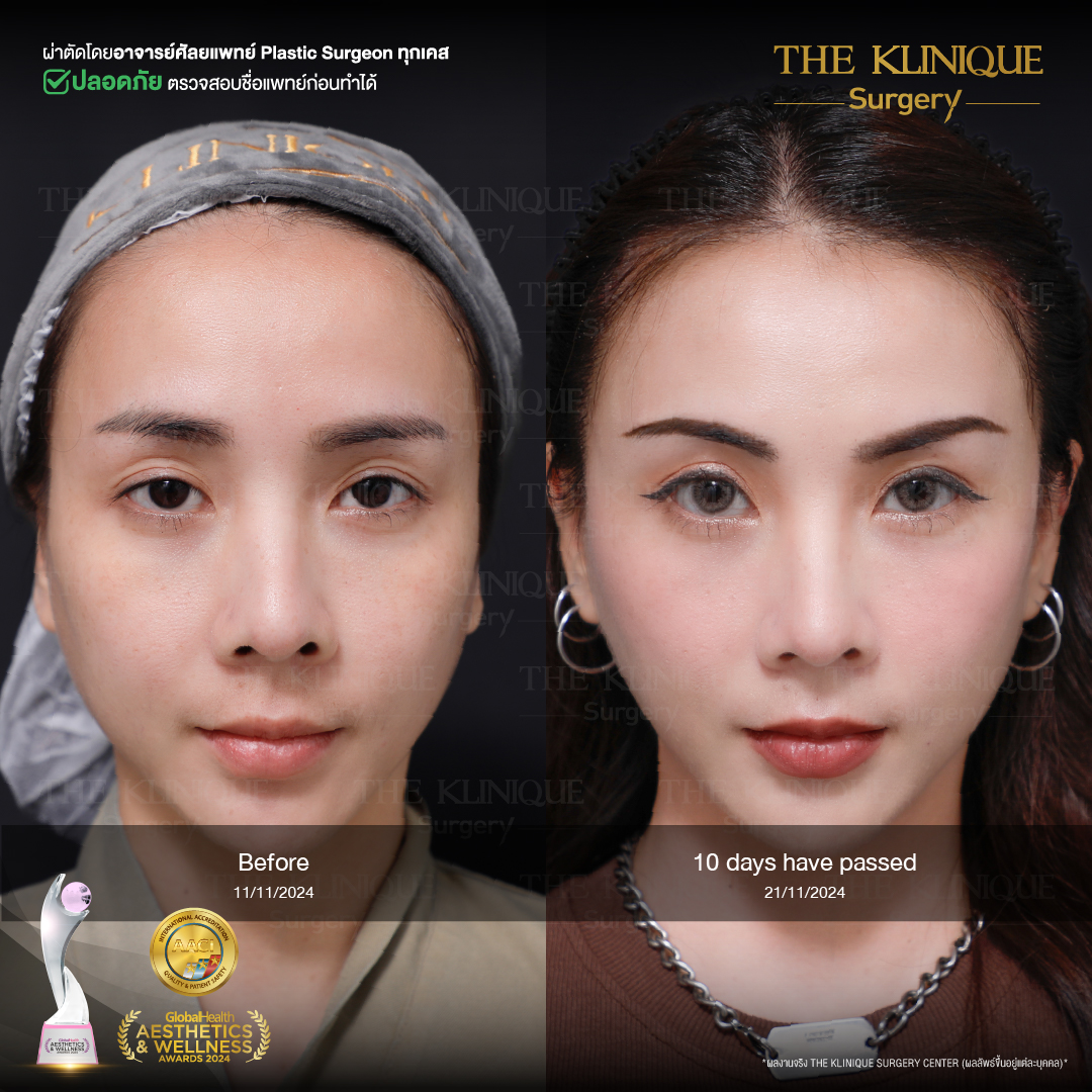 ดึงหน้าดารา, ดึงหน้า, ศัลยกรรมดึงหน้า,ดึงหน้าย้อนวัย, ดึงหน้าที่ไหนดี, ผ่าตัดดึงหน้า, ยกคิ้ว, ยกหางตา, หางตาตก, ดึงหน้าดารา, ดึงหน้ารีวิว, Facelift, Neck lift, Endotine, ยกคิ้ว Endotine,Foxy Eyes, แก้หนังตาตก , แก้ตาไม่เท่ากัน ,หนังตาตก,แก้หนังตาตก,ยกคิ้ว รีวิว, ยกคิ้วส่องกล้อง, ยกคิ้วที่ไหนดี, ยกคิ้ว,ศัลยกรรมยกคิ้ว