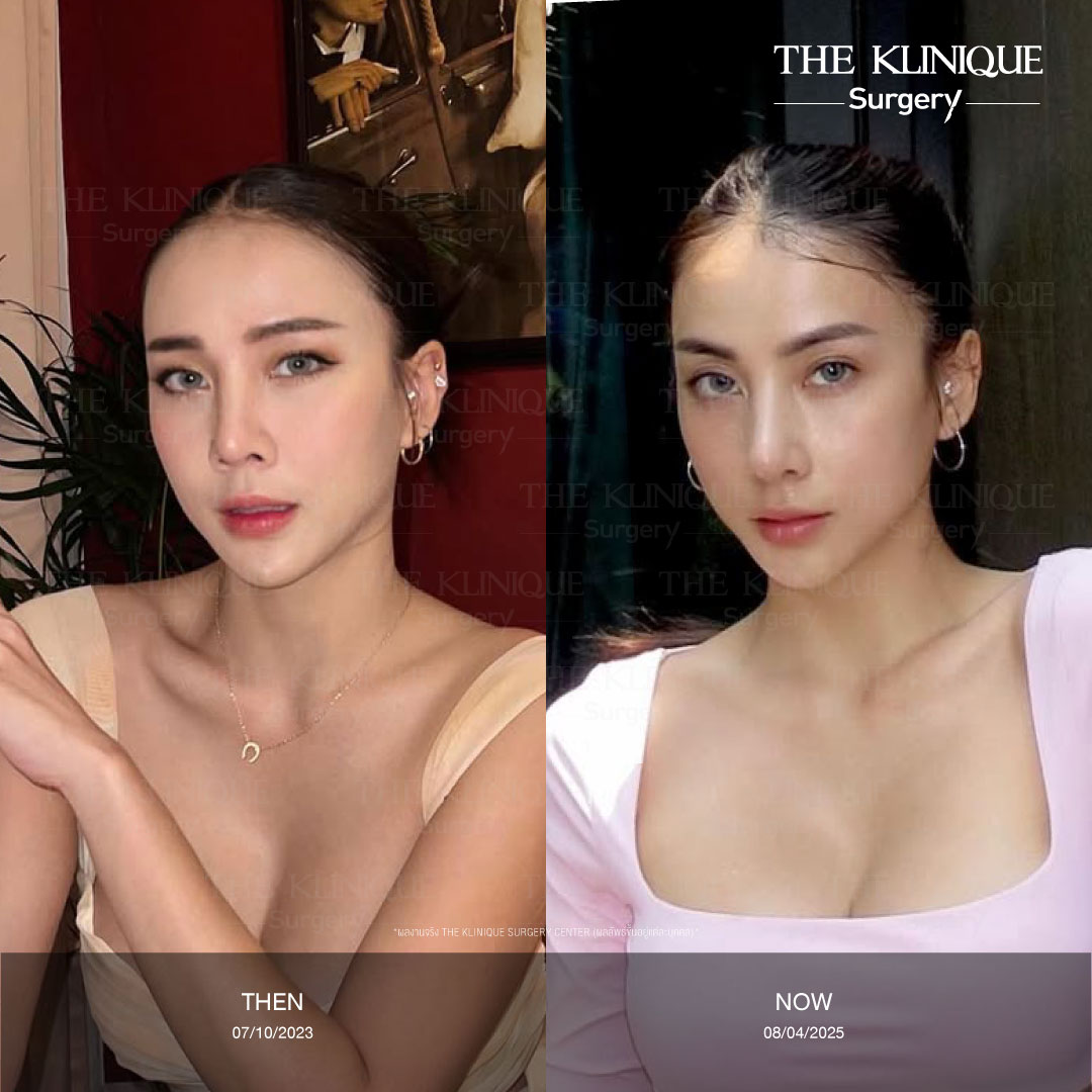 ดึงหน้าดารา, ดึงหน้า, ศัลยกรรมดึงหน้า,ดึงหน้าย้อนวัย, ดึงหน้าที่ไหนดี, ผ่าตัดดึงหน้า, ยกคิ้ว, ยกหางตา, หางตาตก, ดึงหน้าดารา, ดึงหน้ารีวิว, Facelift, Neck lift, Endotine, ยกคิ้ว Endotine,Foxy Eyes, แก้หนังตาตก , แก้ตาไม่เท่ากัน ,หนังตาตก,แก้หนังตาตก,ยกคิ้ว รีวิว, ยกคิ้วส่องกล้อง, ยกคิ้วที่ไหนดี, ยกคิ้ว,ศัลยกรรมยกคิ้ว