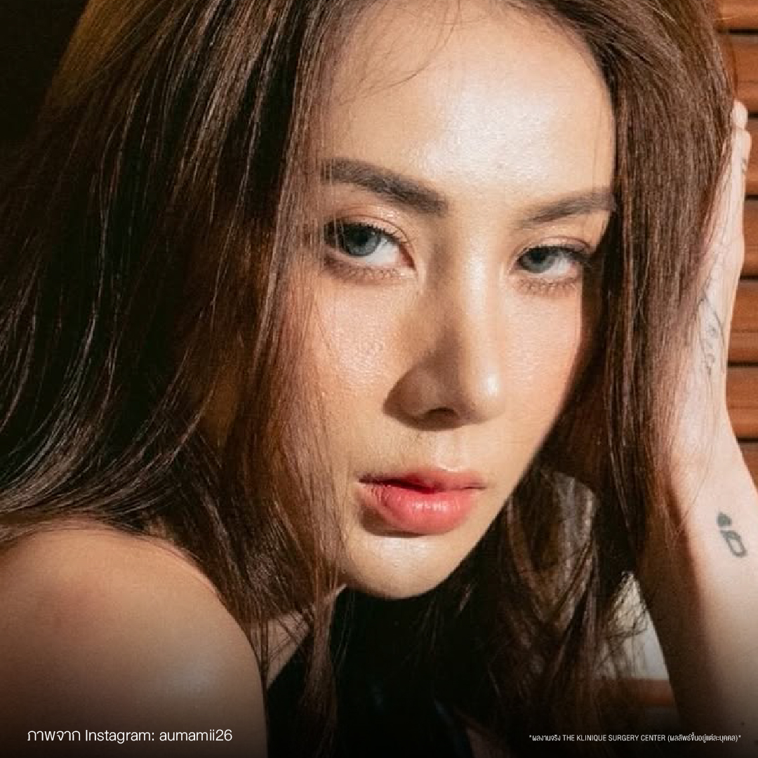 ดึงหน้าดารา, ดึงหน้า, ศัลยกรรมดึงหน้า,ดึงหน้าย้อนวัย, ดึงหน้าที่ไหนดี, ผ่าตัดดึงหน้า, ยกคิ้ว, ยกหางตา, หางตาตก, ดึงหน้าดารา, ดึงหน้ารีวิว, Facelift, Neck lift, Endotine, ยกคิ้ว Endotine,Foxy Eyes, แก้หนังตาตก , แก้ตาไม่เท่ากัน ,หนังตาตก,แก้หนังตาตก,ยกคิ้ว รีวิว, ยกคิ้วส่องกล้อง, ยกคิ้วที่ไหนดี, ยกคิ้ว,ศัลยกรรมยกคิ้ว