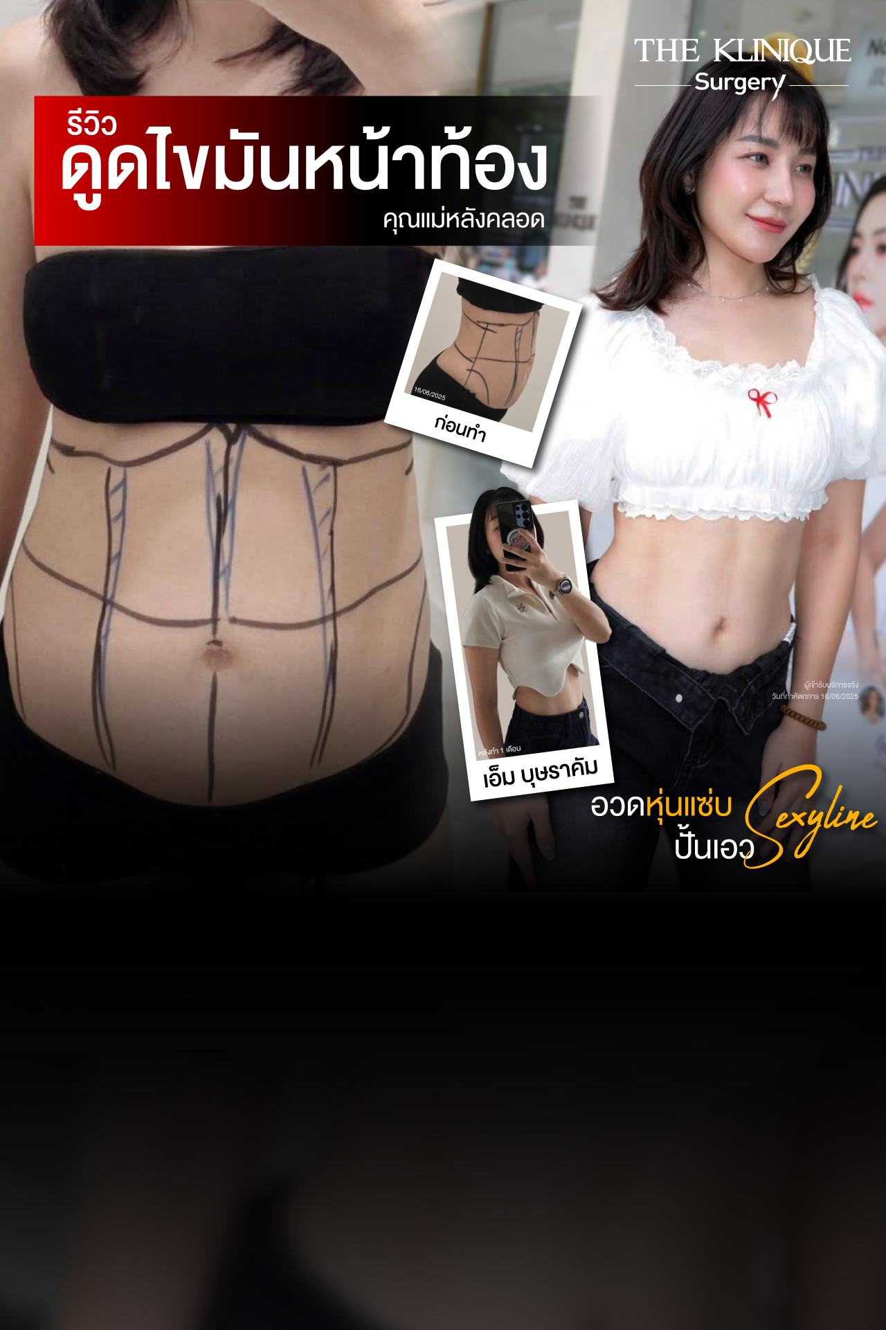 Liposuction, Sculpting,Xshape,Lipo, ศัลยกรรมดูดไขมัน, ดูดไขมัน,คลินิกดูดไขมัน,ดูดไขมันเฉพาะส่วน,ดูดไขมันเหนียง,ดูดไขมันหน้าท้อง,ดูดไขมันรีวิว, รีวิวดูดไขมัน, รีวิวดูดไขมันหน้าท้อง,ดูดไขมันต้นแขน, ดูดไขมันต้นขา,ดูดไขมันน่อง, ลดความอ้วน, ดูดไขมันที่ไหนดี, ดูดไขมันราคา, ดูดไขมันทั้งตัว, รีวิว ดูดไขมันต้นขา, ดูดไขมันขา