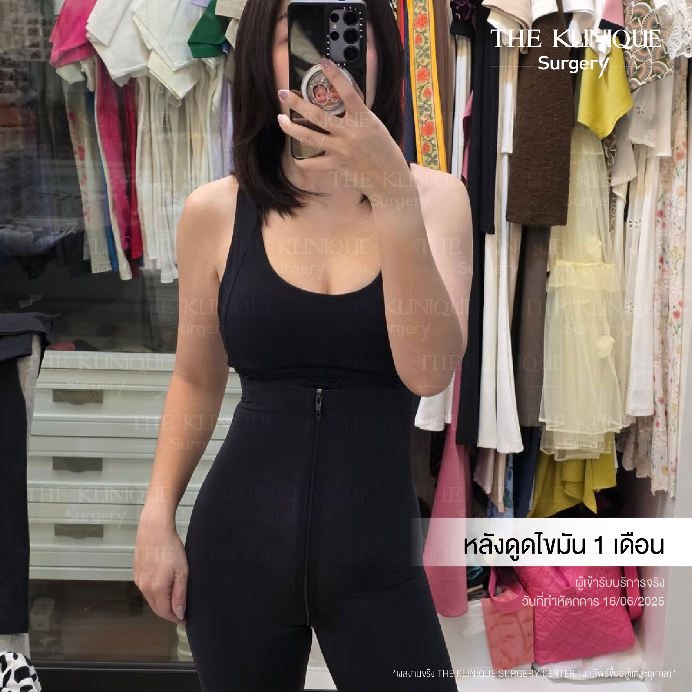 Liposuction, Sculpting,Xshape,Lipo, ศัลยกรรมดูดไขมัน, ดูดไขมัน,คลินิกดูดไขมัน,ดูดไขมันเฉพาะส่วน,ดูดไขมันเหนียง,ดูดไขมันหน้าท้อง,ดูดไขมันรีวิว, รีวิวดูดไขมัน, รีวิวดูดไขมันหน้าท้อง,ดูดไขมันต้นแขน, ดูดไขมันต้นขา,ดูดไขมันน่อง, ลดความอ้วน, ดูดไขมันที่ไหนดี, ดูดไขมันราคา, ดูดไขมันทั้งตัว, รีวิว ดูดไขมันต้นขา, ดูดไขมันขา