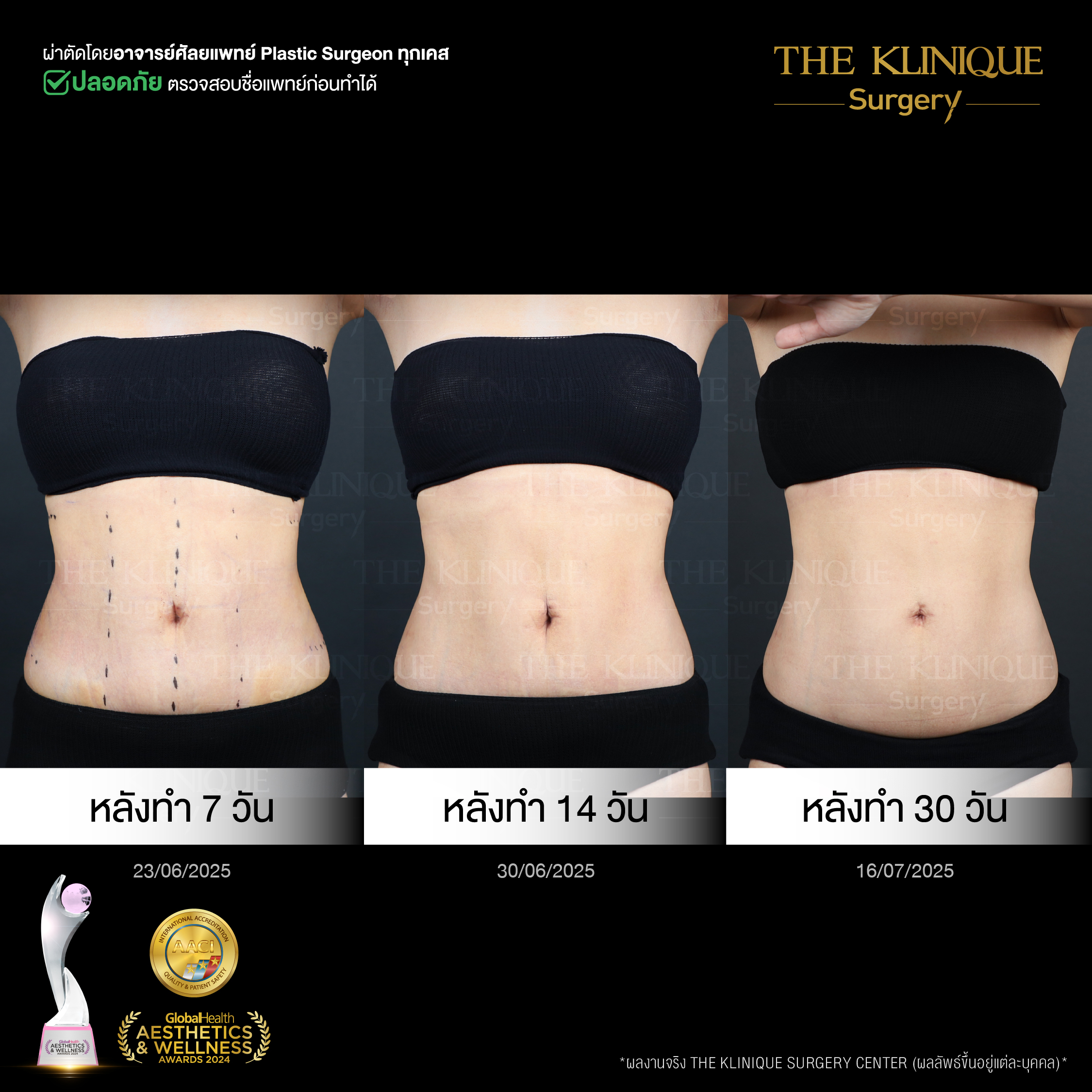 Liposuction, Sculpting,Xshape,Lipo, ศัลยกรรมดูดไขมัน, ดูดไขมัน,คลินิกดูดไขมัน,ดูดไขมันเฉพาะส่วน,ดูดไขมันเหนียง,ดูดไขมันหน้าท้อง,ดูดไขมันรีวิว, รีวิวดูดไขมัน, รีวิวดูดไขมันหน้าท้อง,ดูดไขมันต้นแขน, ดูดไขมันต้นขา,ดูดไขมันน่อง, ลดความอ้วน, ดูดไขมันที่ไหนดี, ดูดไขมันราคา, ดูดไขมันทั้งตัว, รีวิว ดูดไขมันต้นขา, ดูดไขมันขา