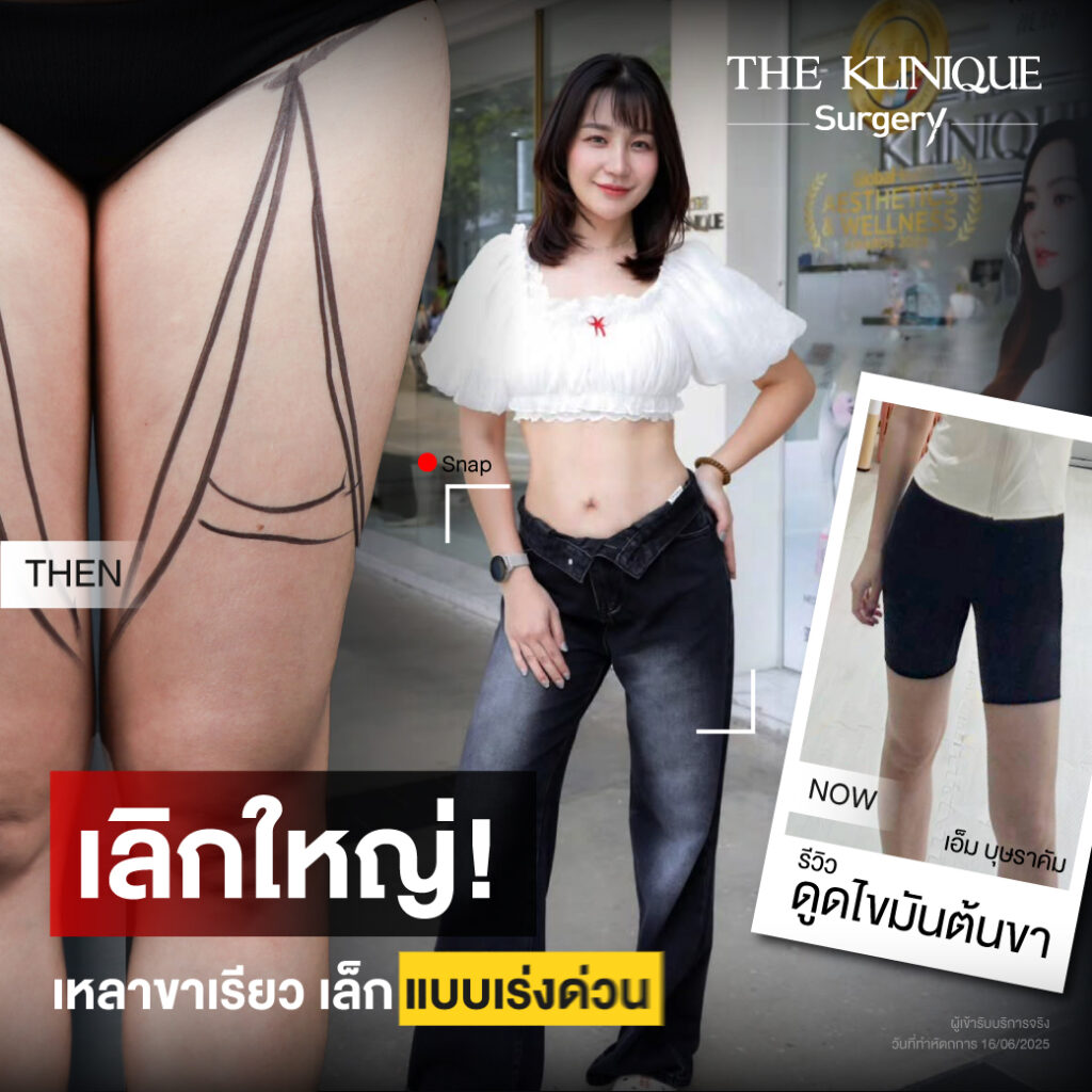 Liposuction, Sculpting,Xshape,Lipo, ศัลยกรรมดูดไขมัน, ดูดไขมัน,คลินิกดูดไขมัน,ดูดไขมันเฉพาะส่วน,ดูดไขมันเหนียง,ดูดไขมันหน้าท้อง,ดูดไขมันรีวิว, รีวิวดูดไขมัน, รีวิวดูดไขมันหน้าท้อง,ดูดไขมันต้นแขน, ดูดไขมันต้นขา,ดูดไขมันน่อง, ลดความอ้วน, ดูดไขมันที่ไหนดี, ดูดไขมันราคา, ดูดไขมันทั้งตัว,รีวิวดูดไขมันต้นขา, ลดไขมันต้นขา, เหลาเขาเรียว