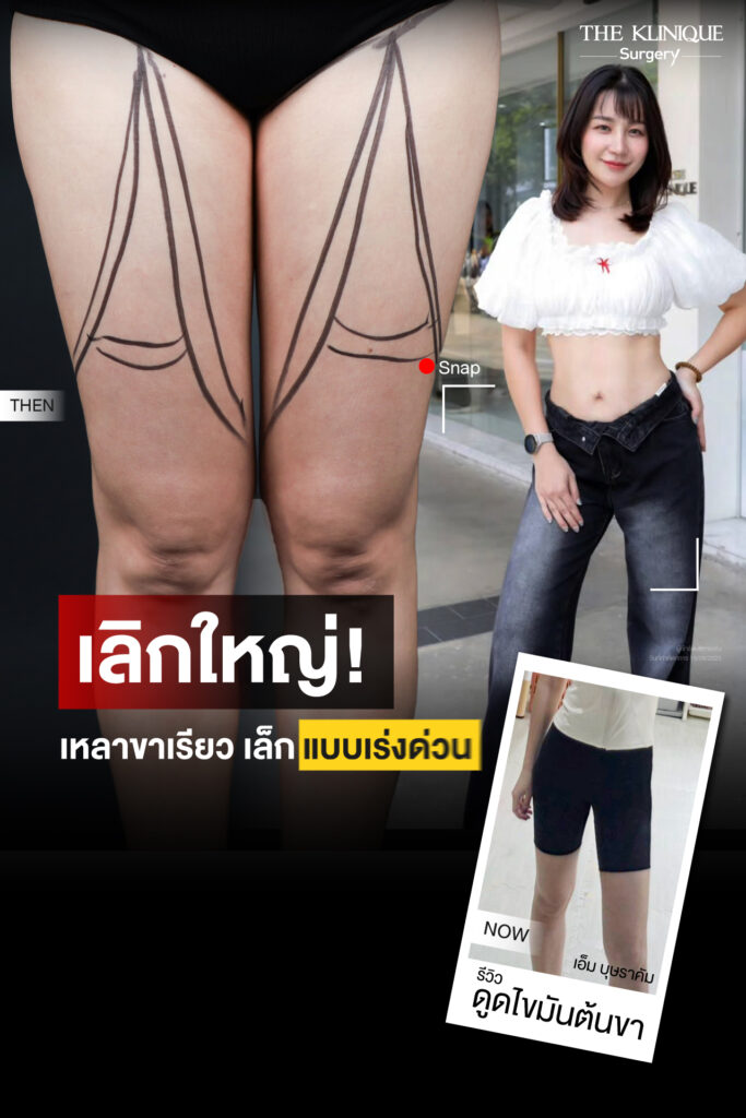 Liposuction, Sculpting,Xshape,Lipo, ศัลยกรรมดูดไขมัน, ดูดไขมัน,คลินิกดูดไขมัน,ดูดไขมันเฉพาะส่วน,ดูดไขมันเหนียง,ดูดไขมันหน้าท้อง,ดูดไขมันรีวิว, รีวิวดูดไขมัน, รีวิวดูดไขมันหน้าท้อง,ดูดไขมันต้นแขน, ดูดไขมันต้นขา,ดูดไขมันน่อง, ลดความอ้วน, ดูดไขมันที่ไหนดี, ดูดไขมันราคา, ดูดไขมันทั้งตัว,รีวิวดูดไขมันต้นขา, ลดไขมันต้นขา, เหลาเขาเรียว